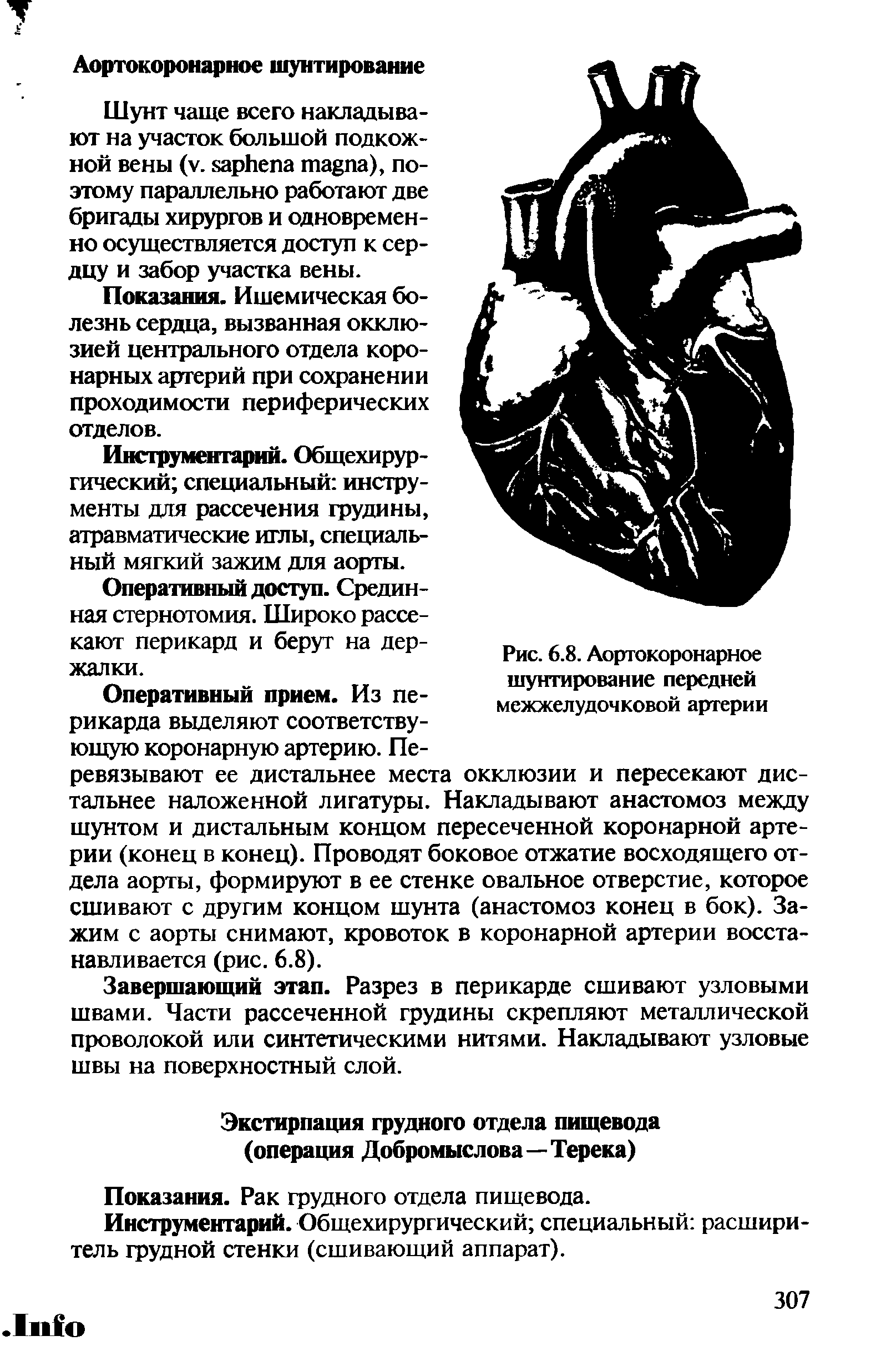 Рис. 6.8. Аортокоронарное шунтирование передней межжелудочковой артерии окклюзии и пересекают дис-...