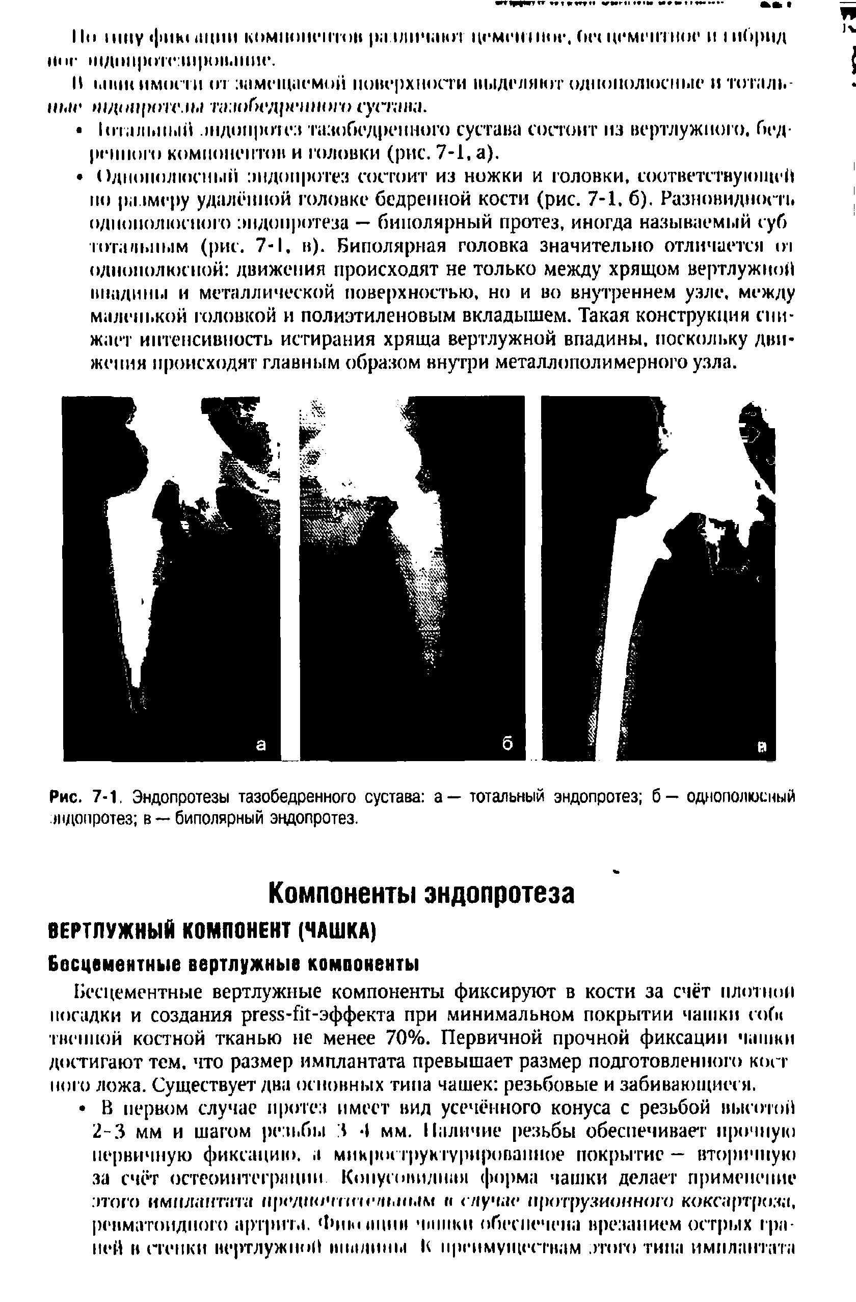 Рис. 7-1. Эндопротезы тазобедренного сустава а — тотальный эндопротез б - однополюсный эндопротез в —биполярный эндопротез.