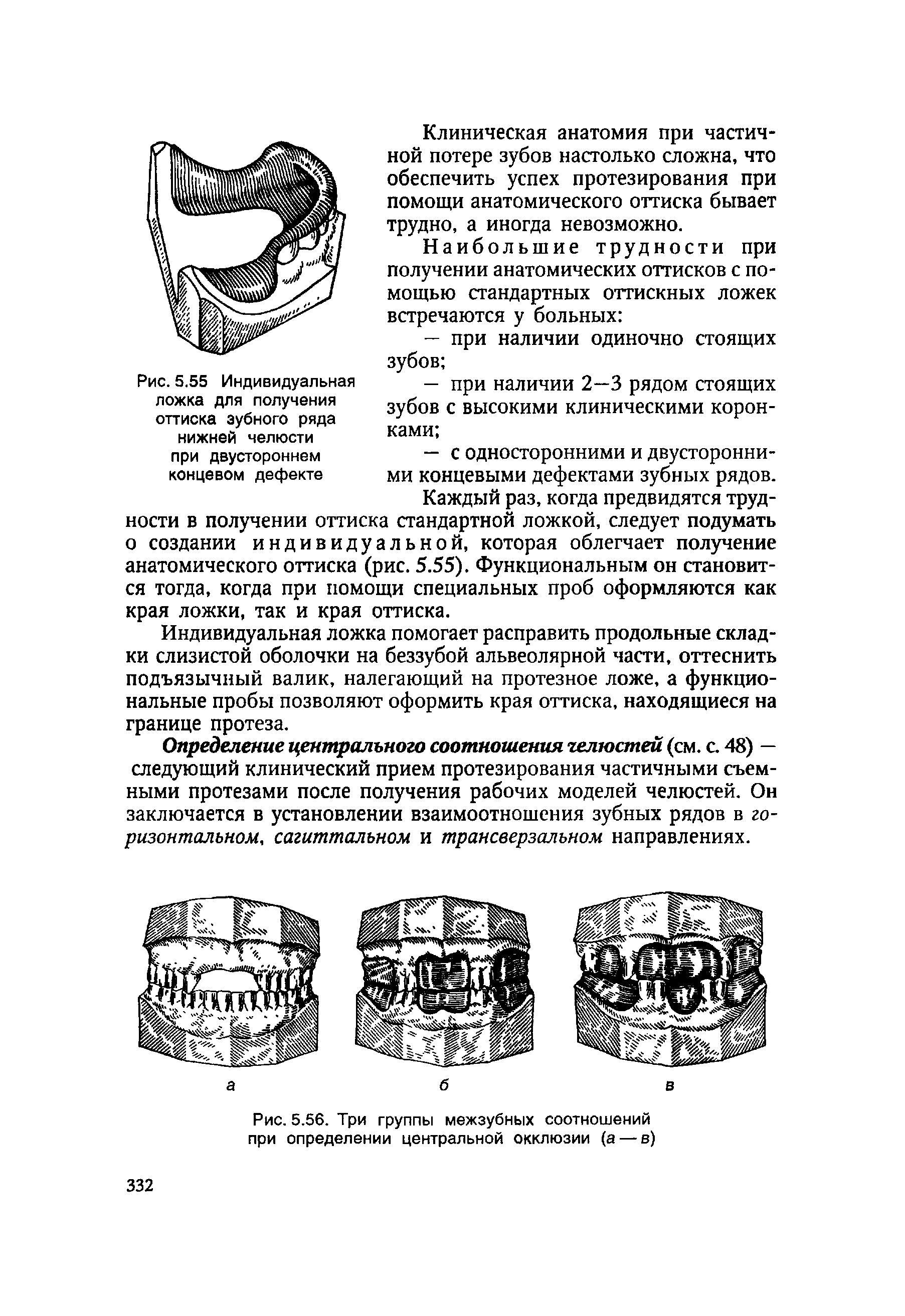 Рис. 5.56. Три группы межзубных соотношений при определении центральной окклюзии (а — в)...