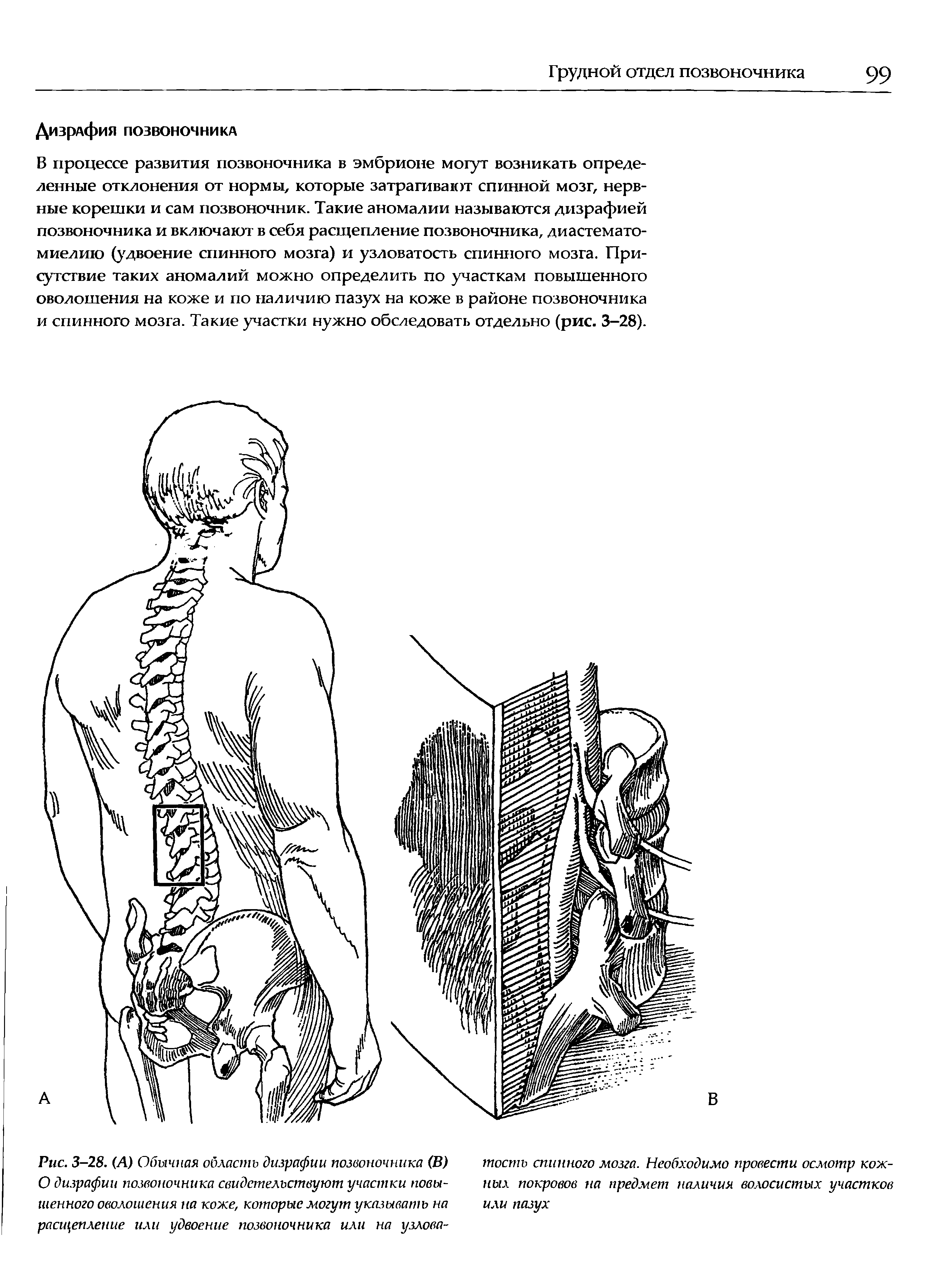 Рис. 3-28. (А) Обычная область дизрафии позвоночника (В) О дизрафии позвоночника свидетельствуют участки повышенного оволошения на коже, которые могут указывать на расщепление или удвоение позвоночника или на узлова-...