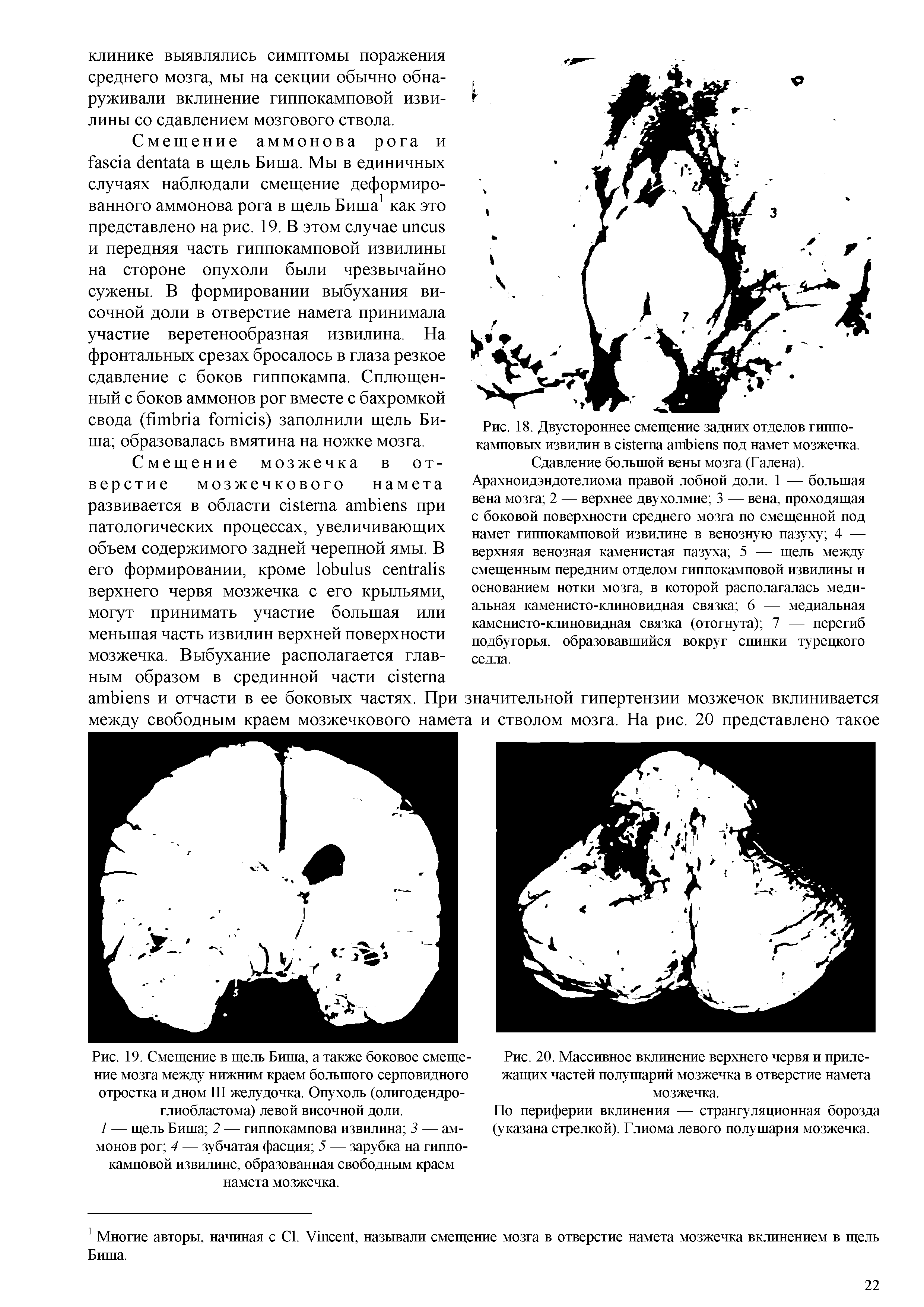 Рис. 18. Двустороннее смещение задних отделов гиппокамповых извилин в под намет мозжечка. Сдавление большой вены мозга (Галена).