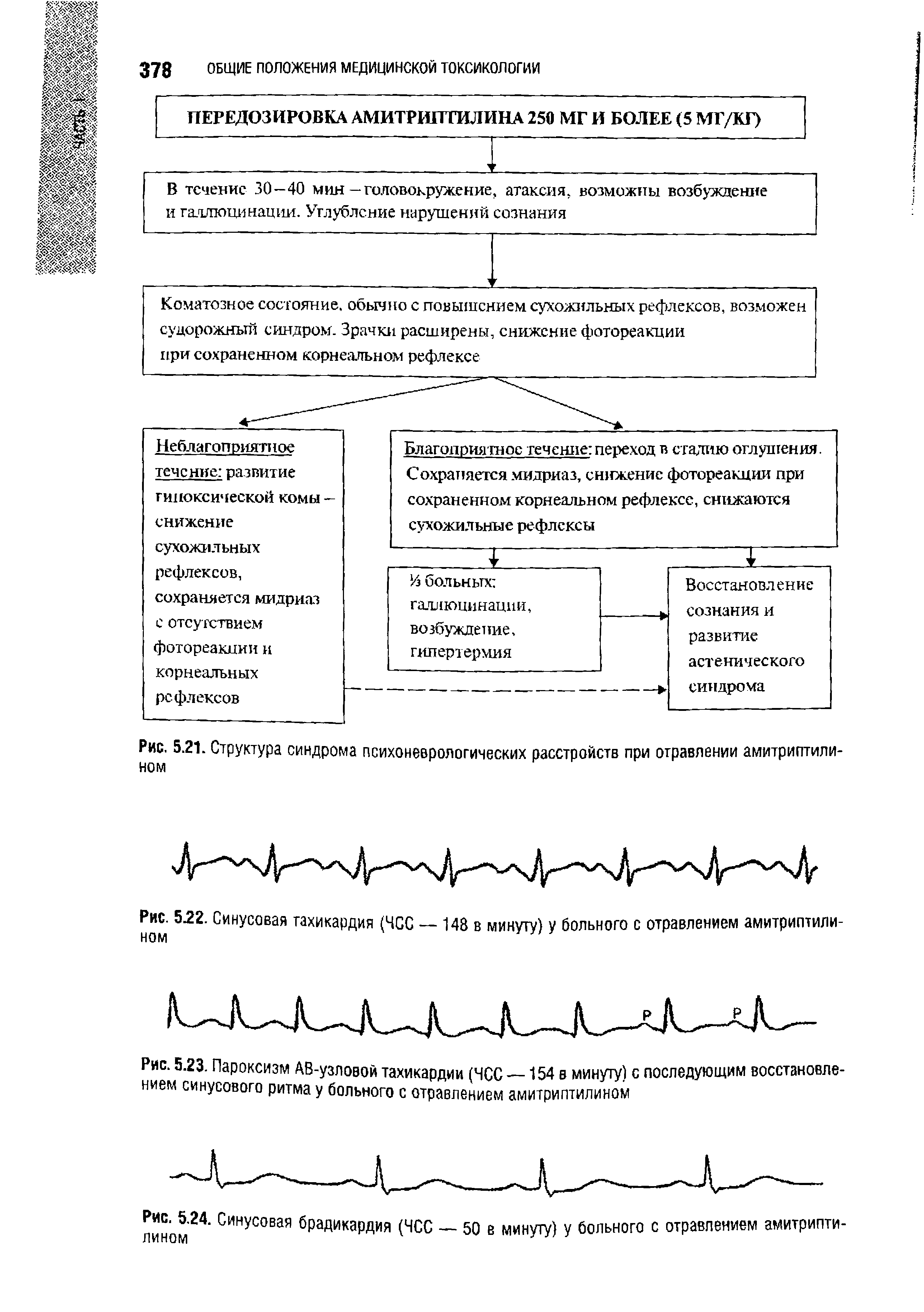 Рис. 5.21. Структура синдрома психоневрологических расстройств при отравлении амитриптилином...