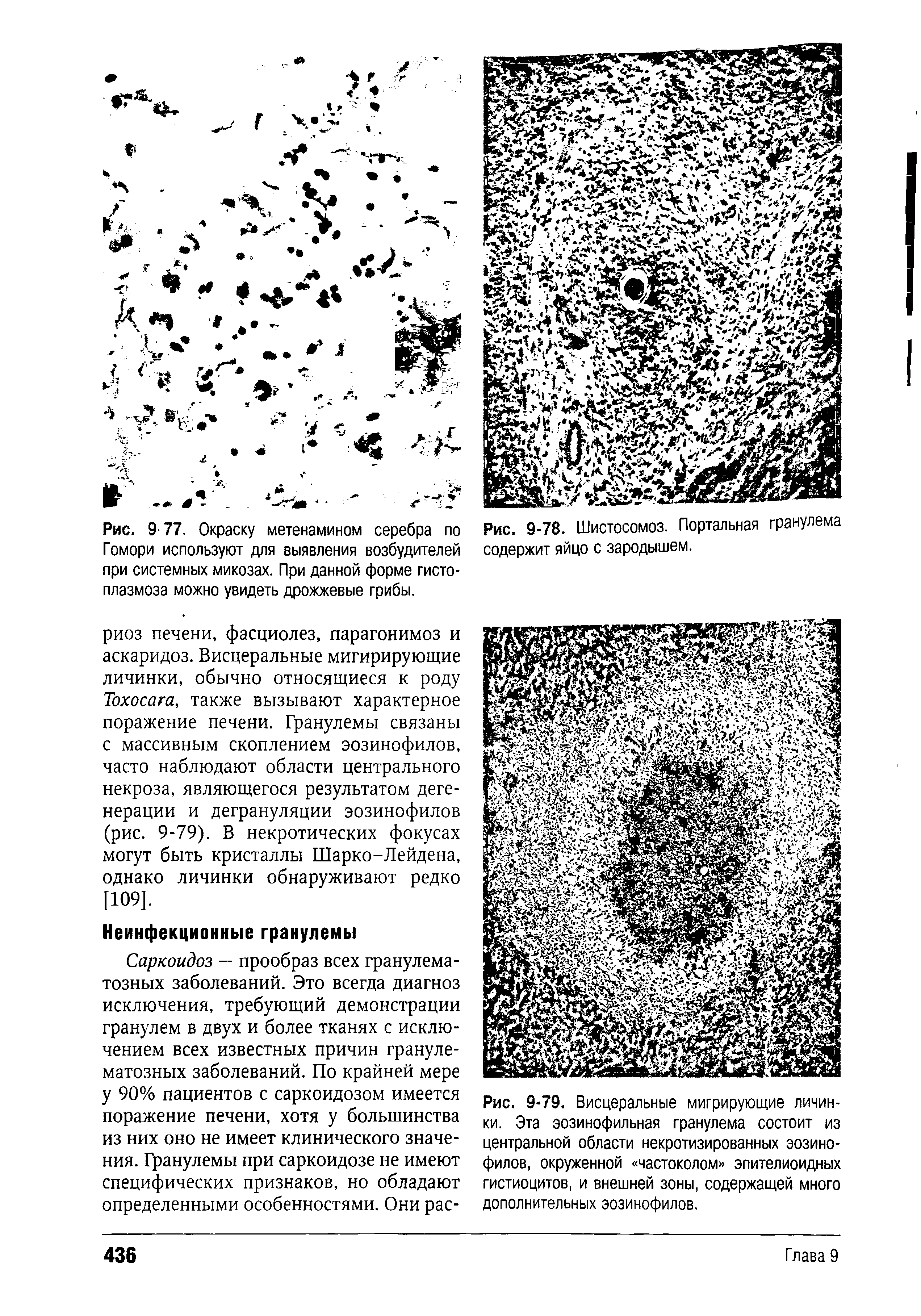 Рис. 9-79. Висцеральные мигрирующие личинки. Эта эозинофильная гранулема состоит из центральной области некротизированных эозинофилов, окруженной частоколом эпителиоидных гистиоцитов, и внешней зоны, содержащей много дополнительных эозинофилов.