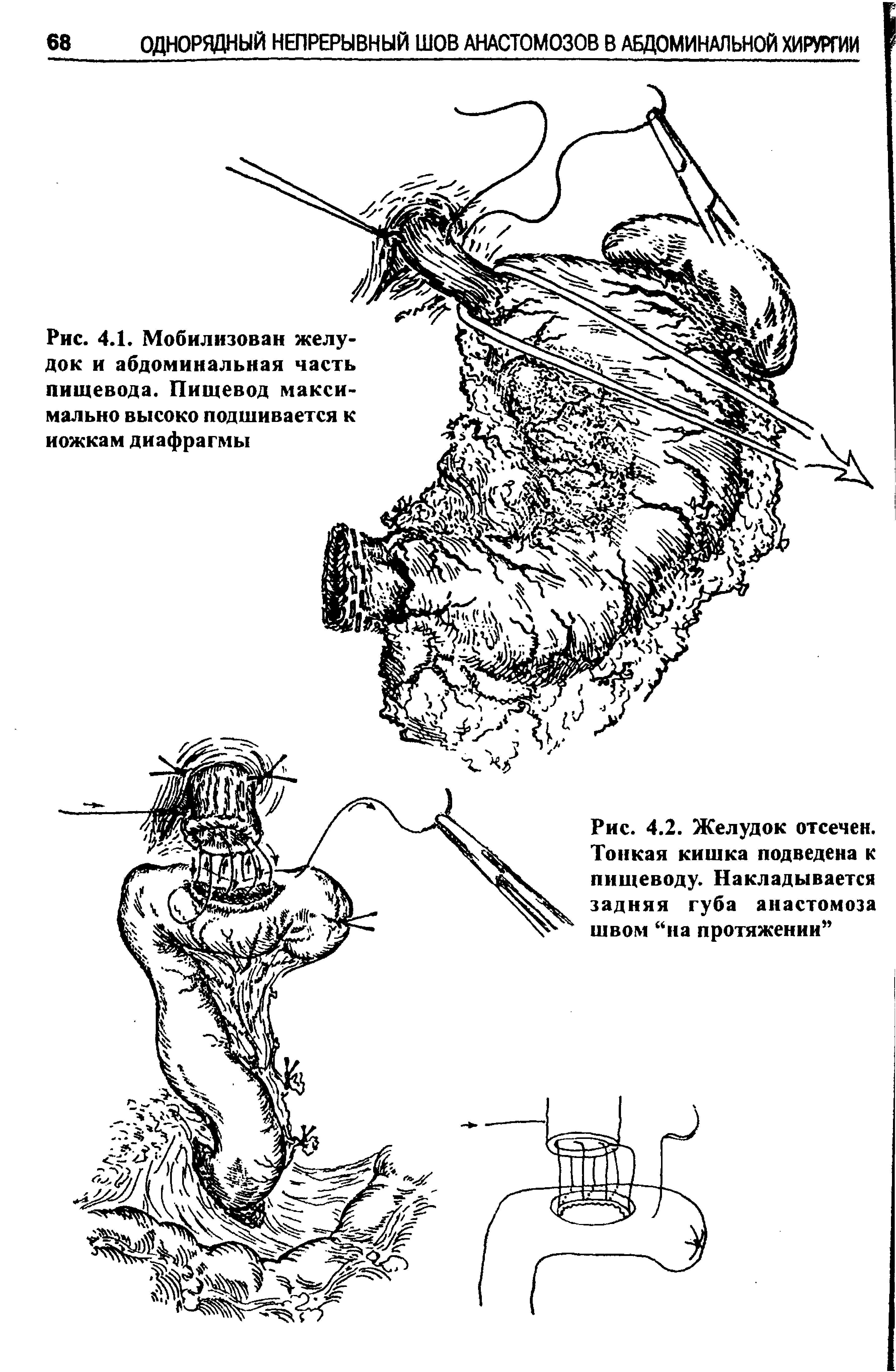 Рис. 4.2. Желудок отсечен. Тонкая кишка подведена к пищеводу. Накладывается задняя губа анастомоза швом на протяжении ...