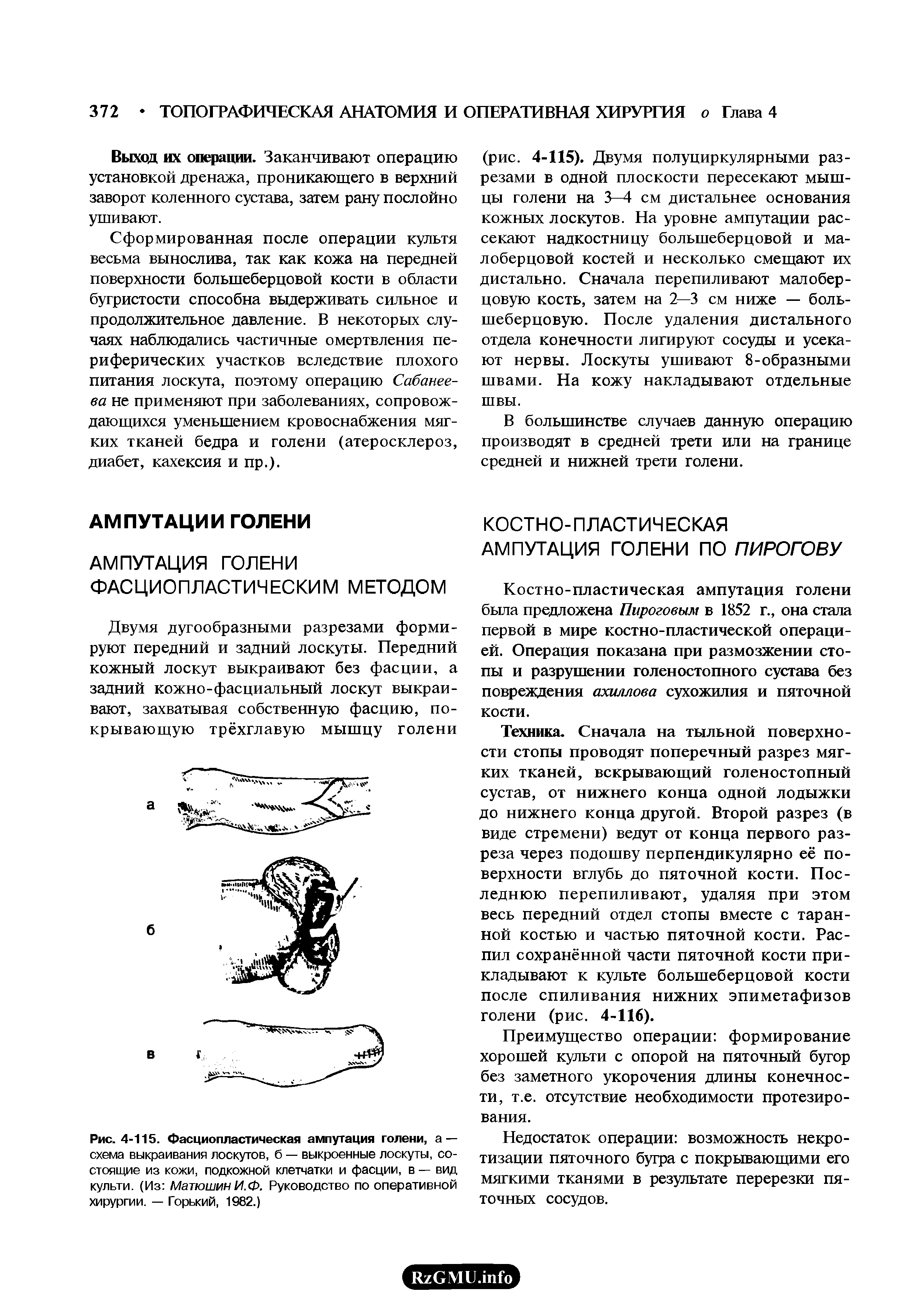 Рис. 4-115. Фасциопластическая ампутация голени, а — схема выкраивания лоскутов, б — выкроенные лоскуты, состоящие из кожи, подкожной клетчатки и фасции, в — вид культи. (Из Матюшин И. Ф. Руководство по оперативной хирургии. — Горький, 1982.)...