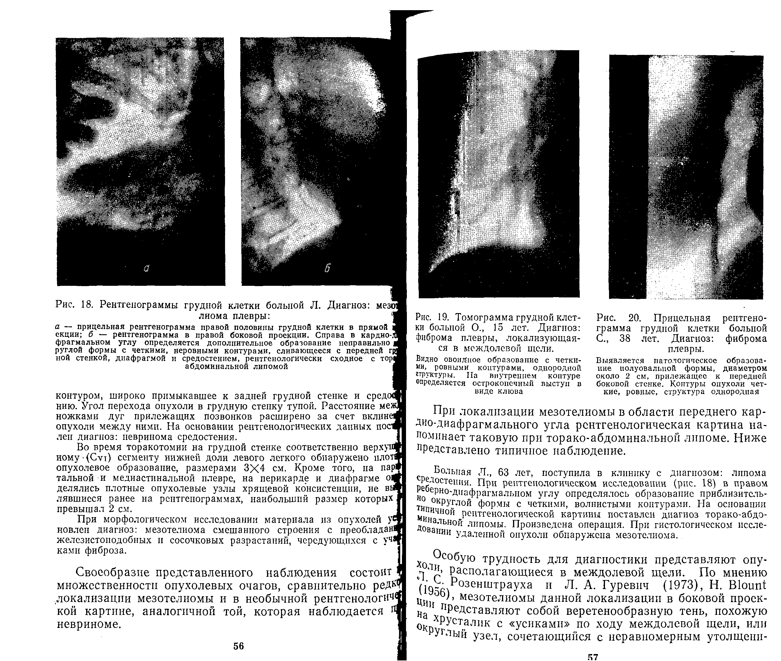 Рис. 19. Томограмма грудной клетки больной О., 15 лет. Диагноз фиброма плевры, локализующаяся в междолевой щели.