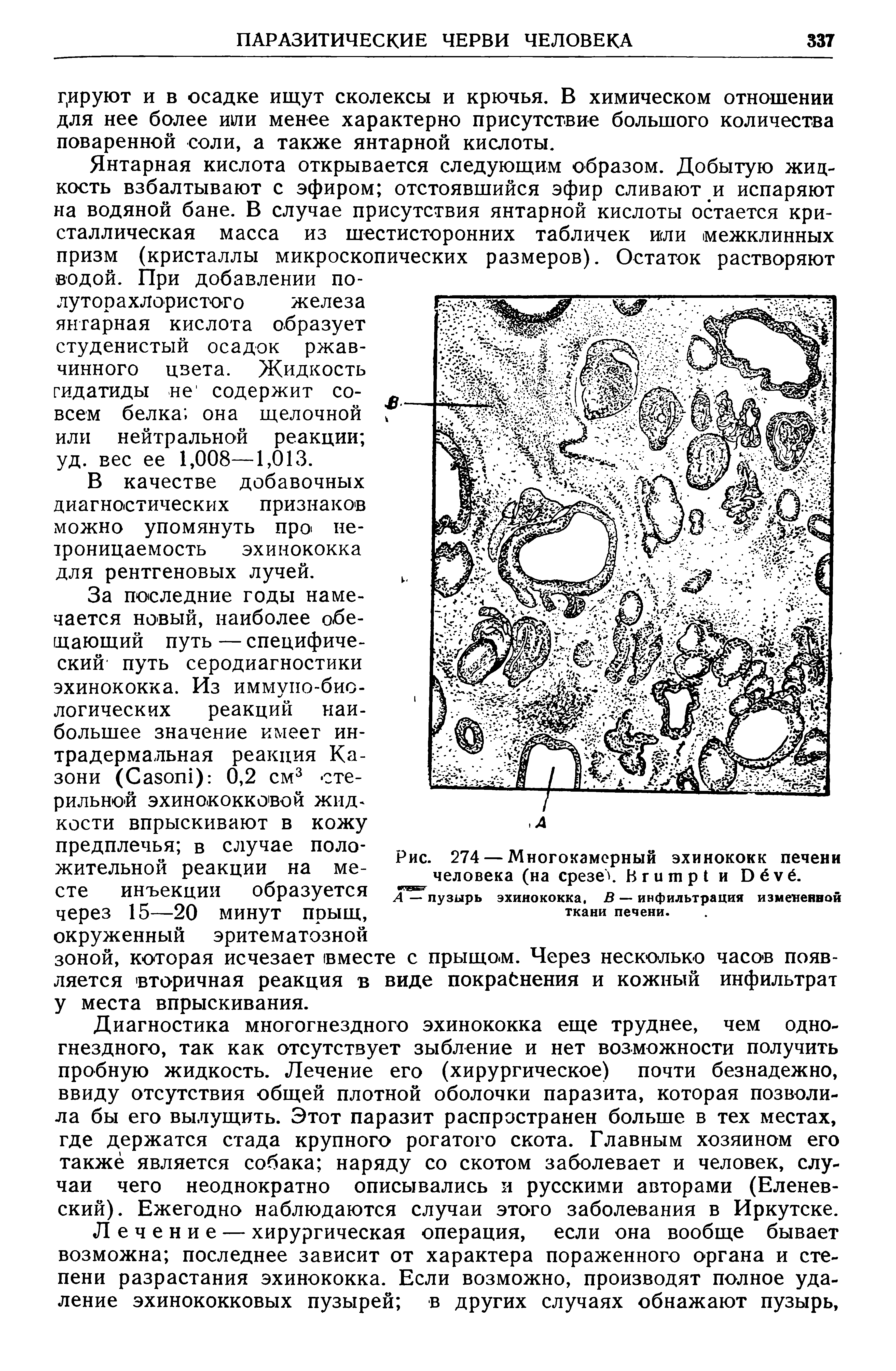 Рис. 274 — Многокамерный эхинококк печени человека (на срезе Вгишр1 и Оёуё.