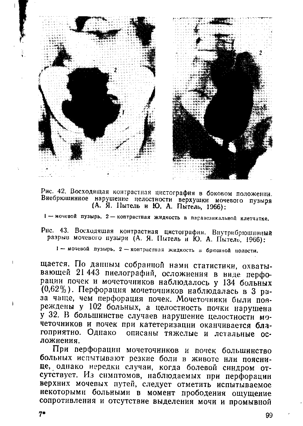 Рис. 43. Восходящая контрастная цистография. Внутрибрюшинный разрыв мочевою пузыря (А. Я. Пытель и Ю. А. Пытель, 1966) ...