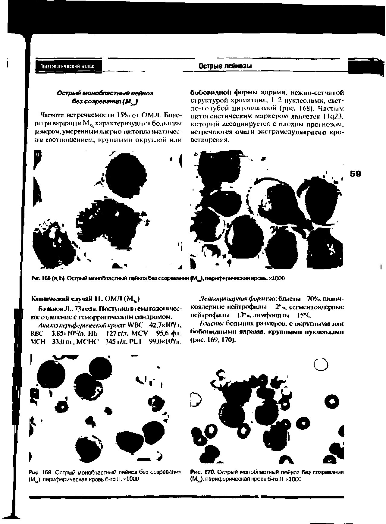 Рис. 169. Острый монобластный лейкоз без созревания (Мм) периферическая кровь б-го Л. х10С0...