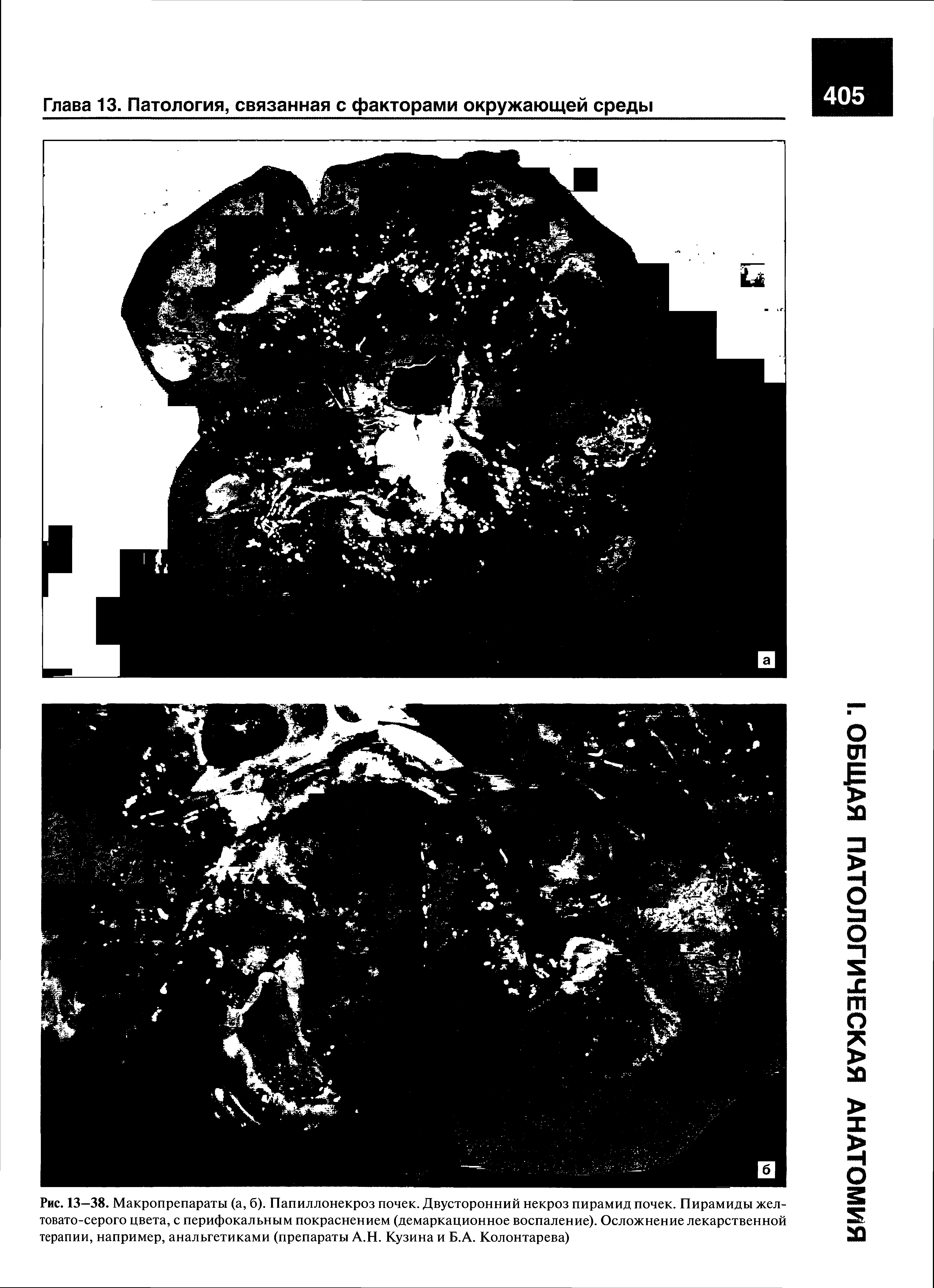 Рис. 13—38. Макропрепараты (а, б). Папиллонекроз почек. Двусторонний некроз пирамид почек. Пирамиды желтовато-серого цвета, с перифокальным покраснением (демаркационное воспаление). Осложнение лекарственной терапии, например, анальгетиками (препараты А.Н. Кузина и Б.А. Колонтарева)...