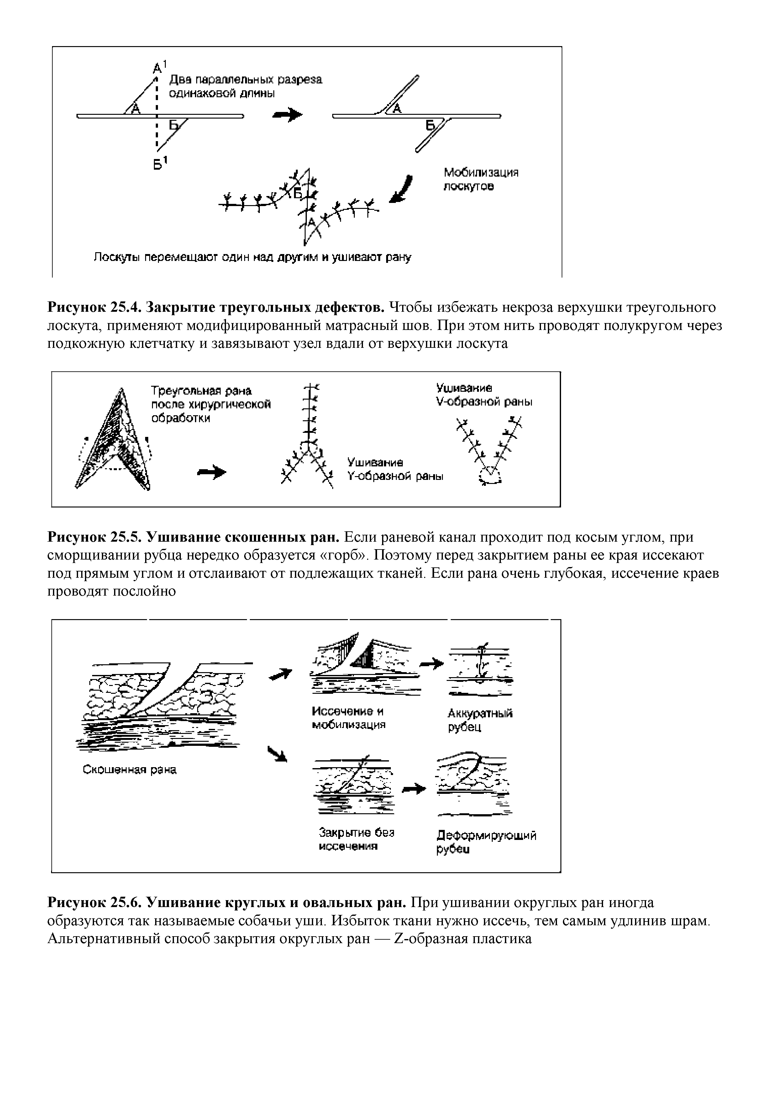 Рисунок 25.4. Закрытие треугольных дефектов. Чтобы избежать некроза верхушки треугольного лоскута, применяют модифицированный матрасный шов. При этом нить проводят полукругом через подкожную клетчатку и завязывают узел вдали от верхушки лоскута...