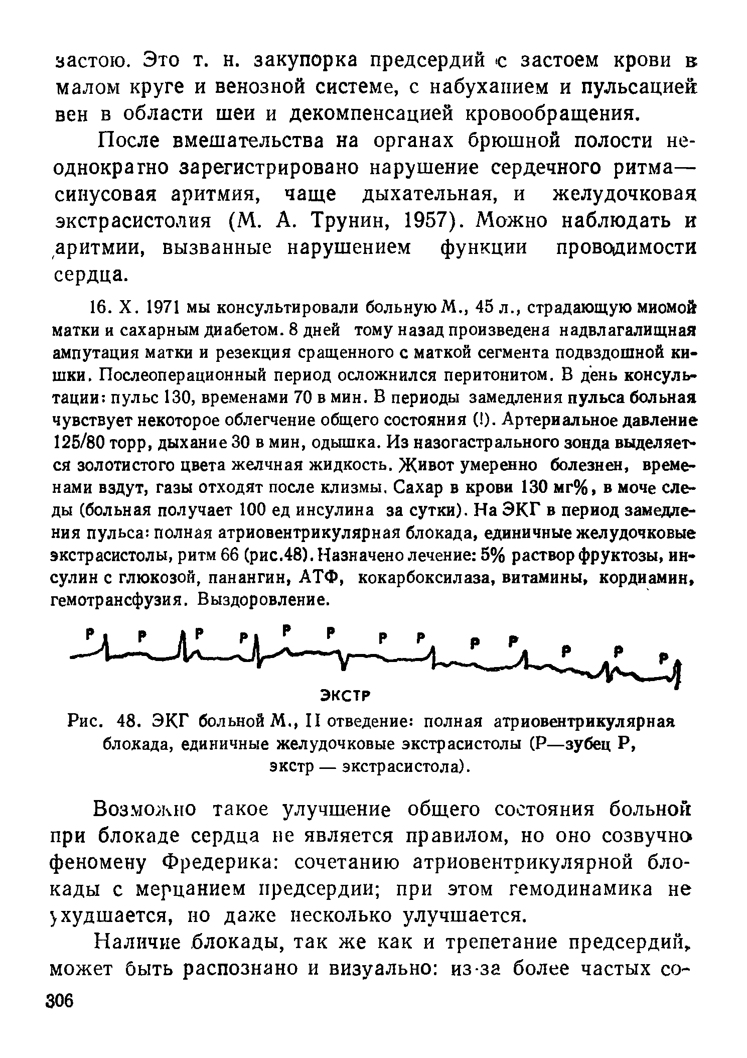 Рис. 48. ЭКГ больной М., II отведение полная атриовентрикулярная блокада, единичные желудочковые экстрасистолы (Р—зубец Р, экстр — экстрасистола).