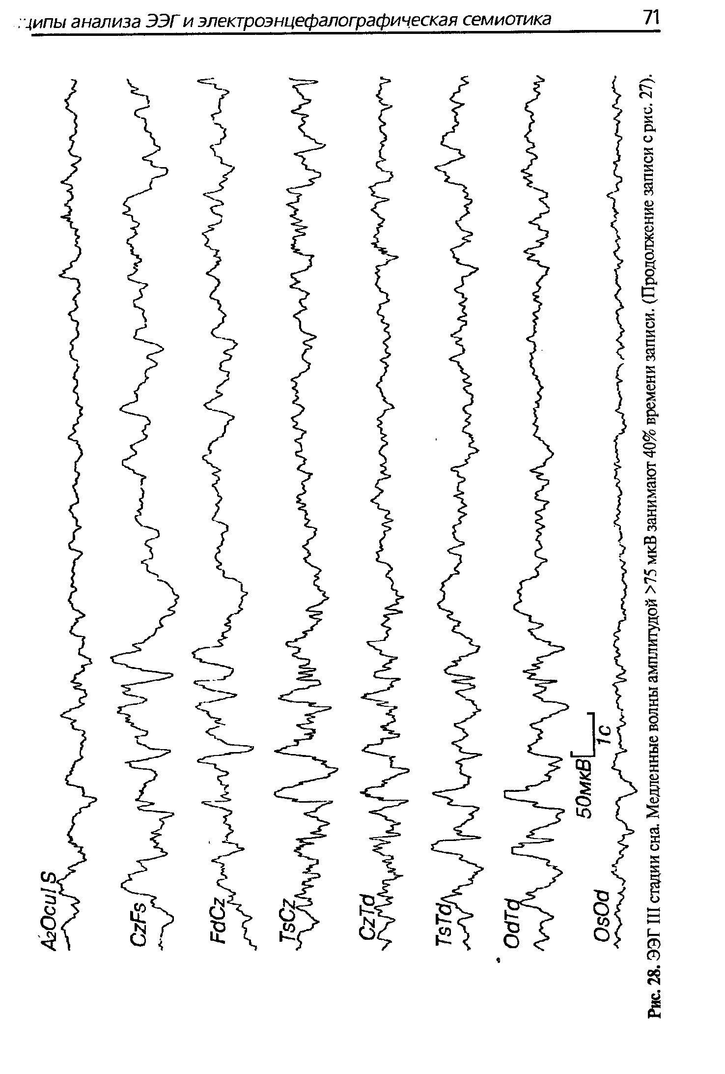 Рис. 28. ЭЭГIII стадии сна. Медленные волны амплитудой >75 мкВ занимают 40% времени записи. (Продолжение записи с рис. 27).