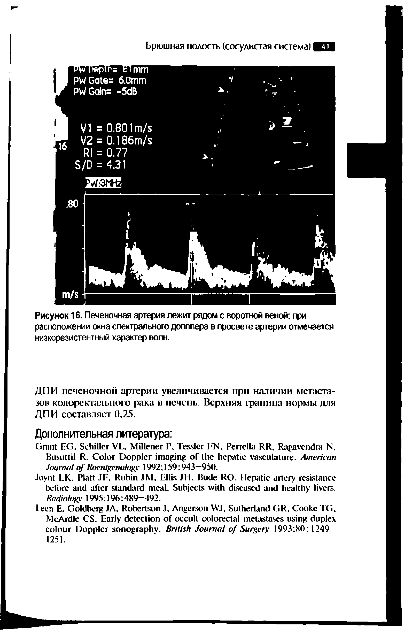 Рисунок 16. Печеночная артерия лежит рядом с воротной веной при расположении окна спектрального допплера в просвете артерии отмечается низкорезистентный характер волн.