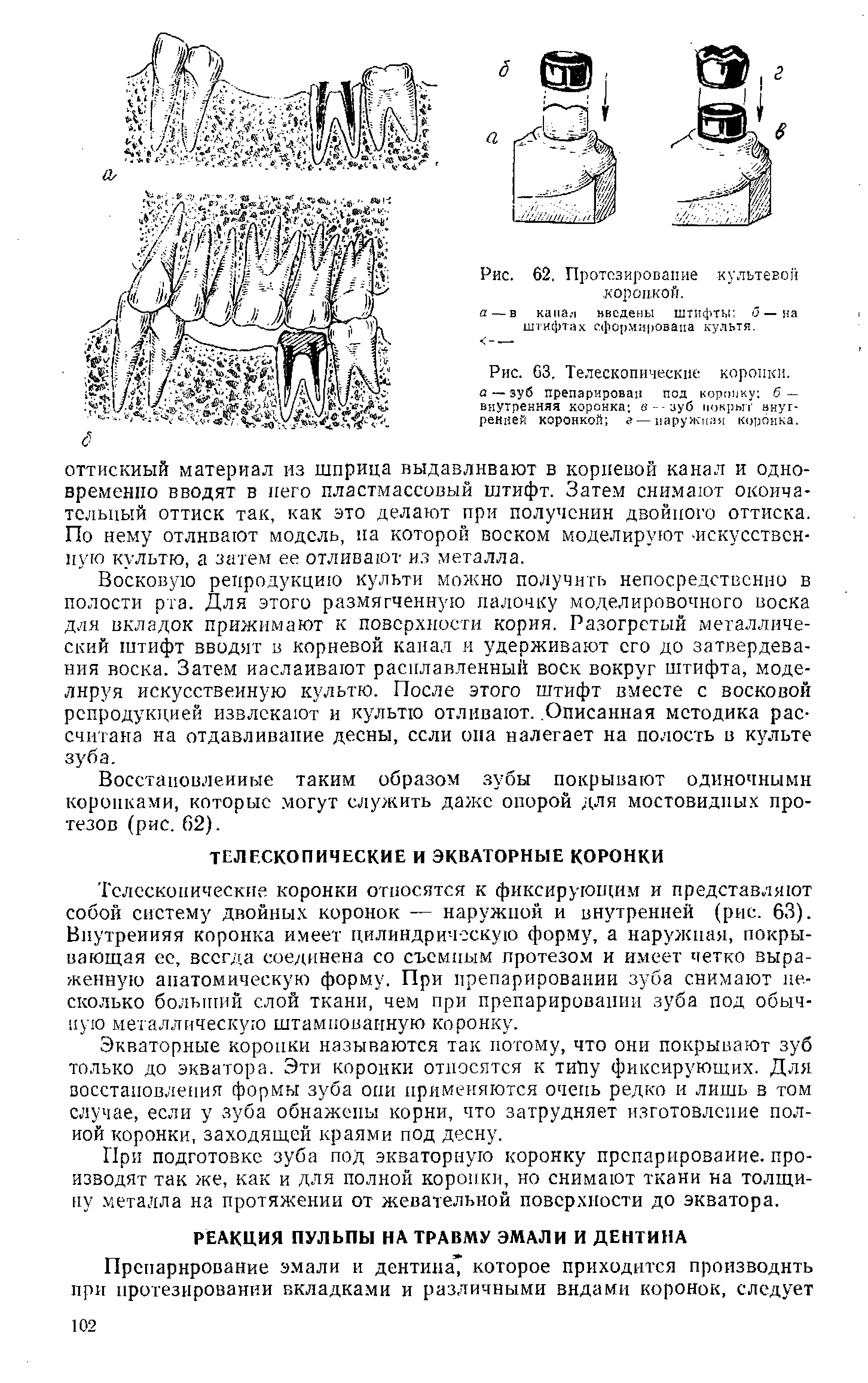 Рис. 63, Телескопические коронки. а — зуб препарирован под коронку б — внутренняя коронка в - - зуб покрыт внутренней коронкой г—наружная коронка.