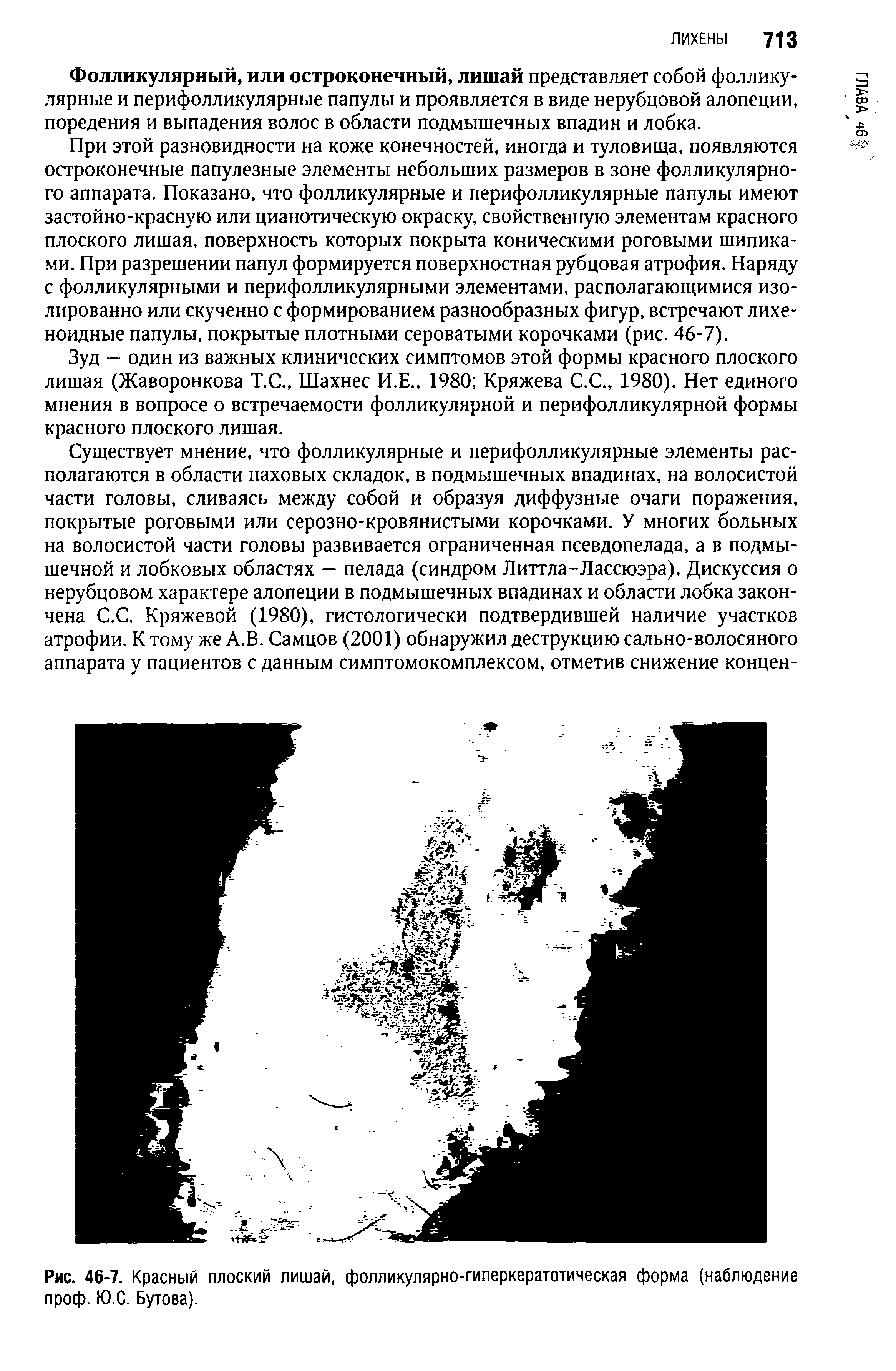 Рис. 46-7. Красный плоский лишай, фолликулярно-гиперкератотическая форма (наблюдение проф. Ю.С. Бутова).