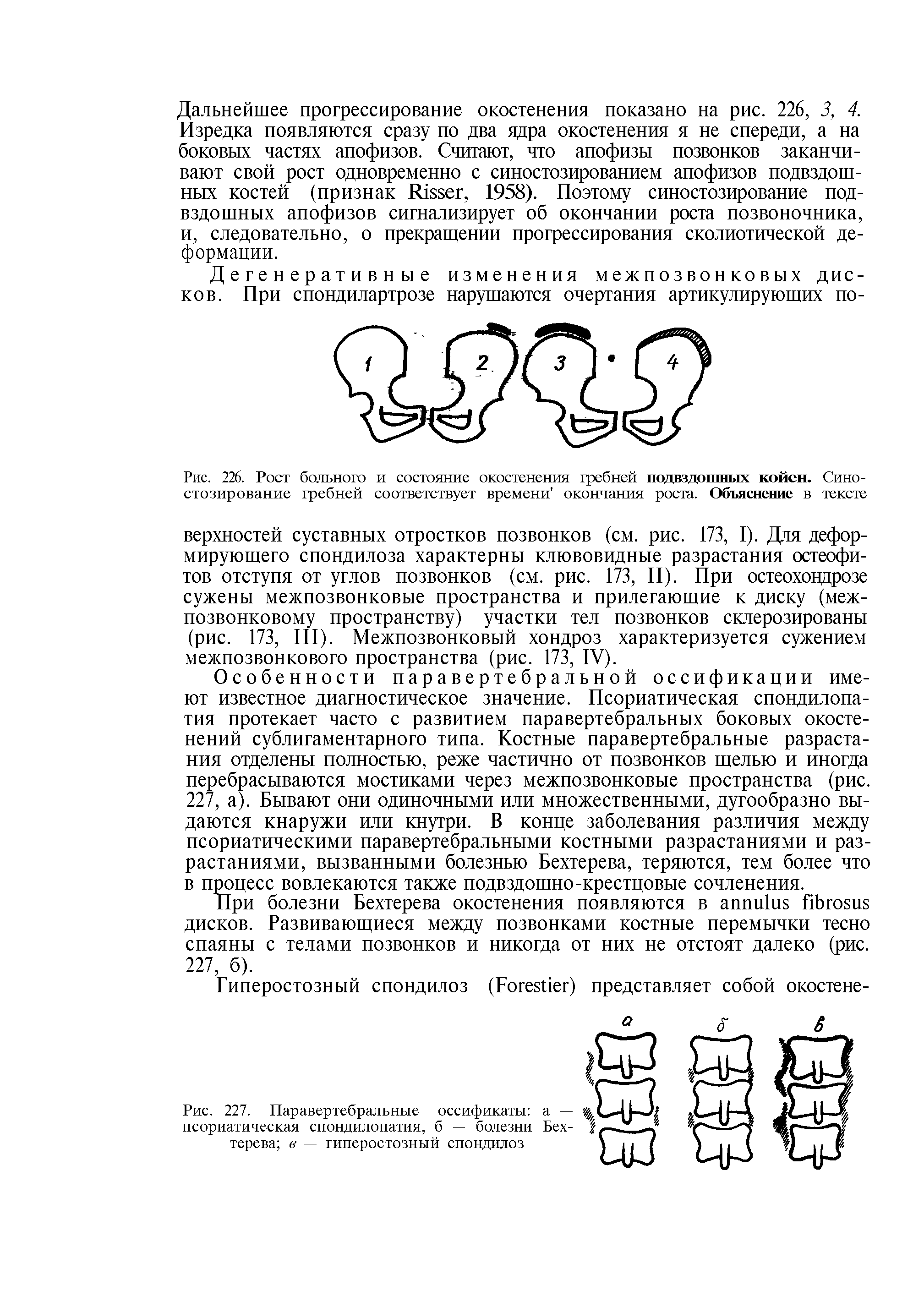 Рис. 227. Паравертебральные оссификаты а — псориатическая спондилопатия, б — болезни Бехтерева в — гиперостозный спондилоз...