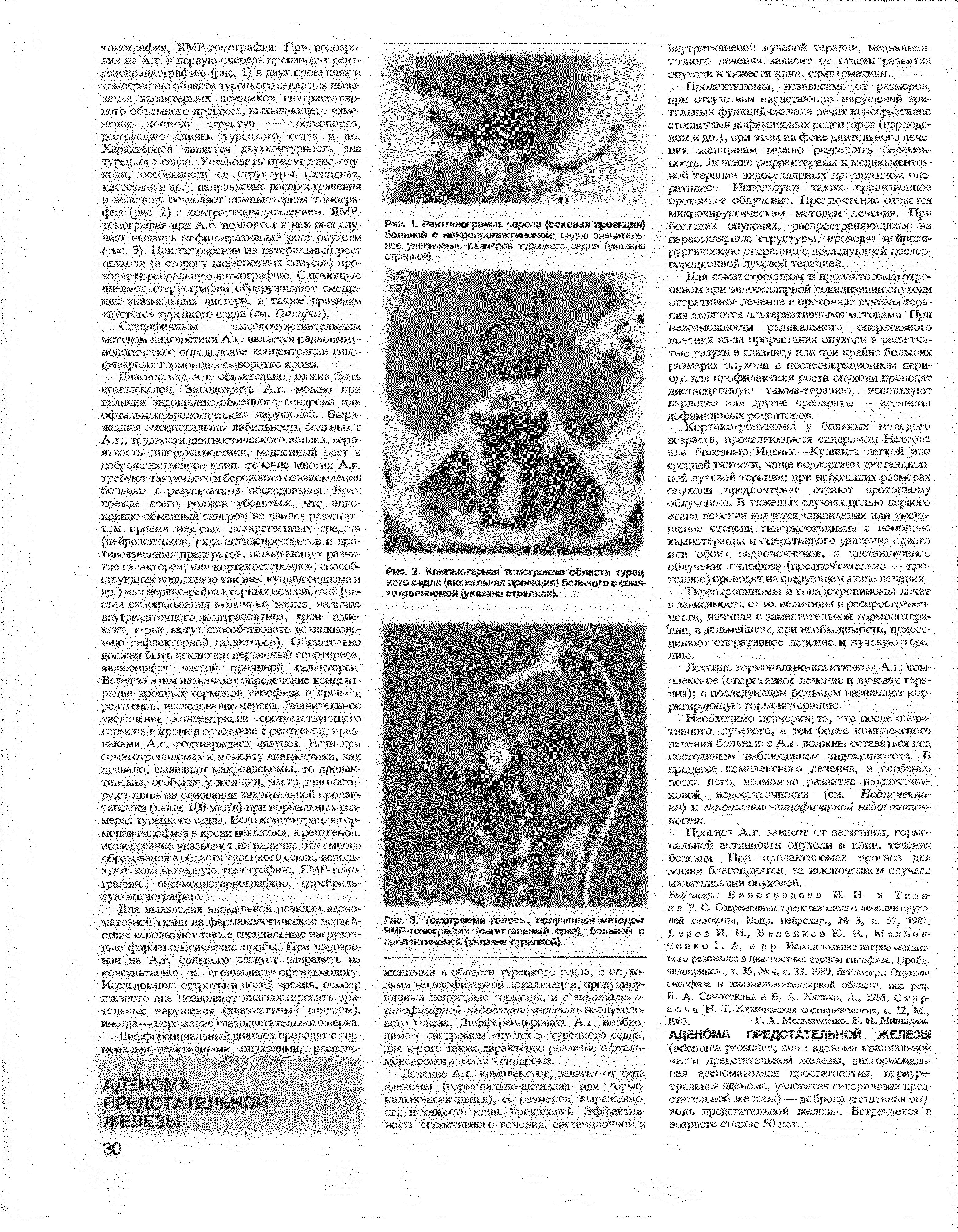 Рис. 2. Компьютерная томограмма области турецкого седла (аксиальная проекция) больного с соматотропиномой (указана стрелкой)...