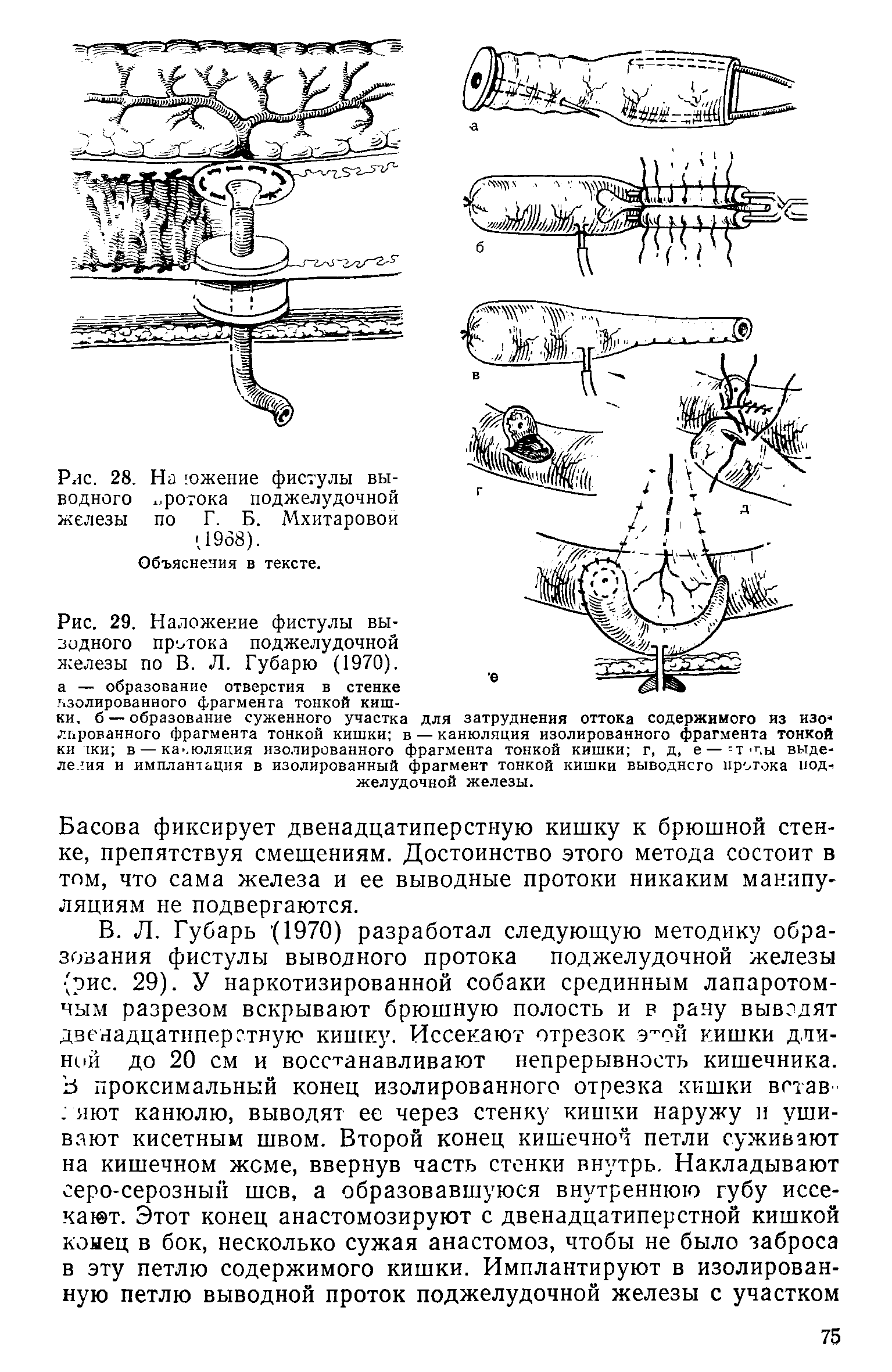 Рис. 29. Наложение фистулы вы-зидного протока поджелудочной железы по В. Л. Губарю (1970).