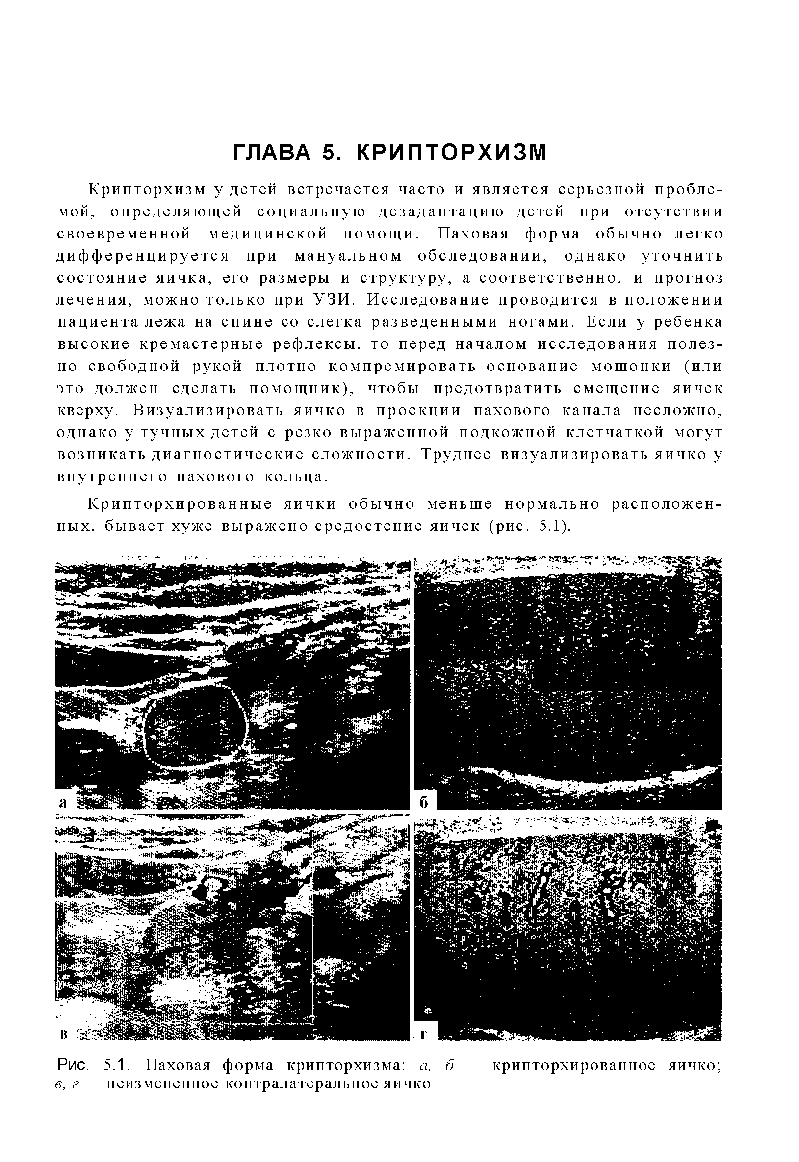 Рис. 5.1. Паховая форма крипторхизма а, б — крипторхированное яичко в, г — неизмененное контралатеральное яичко...