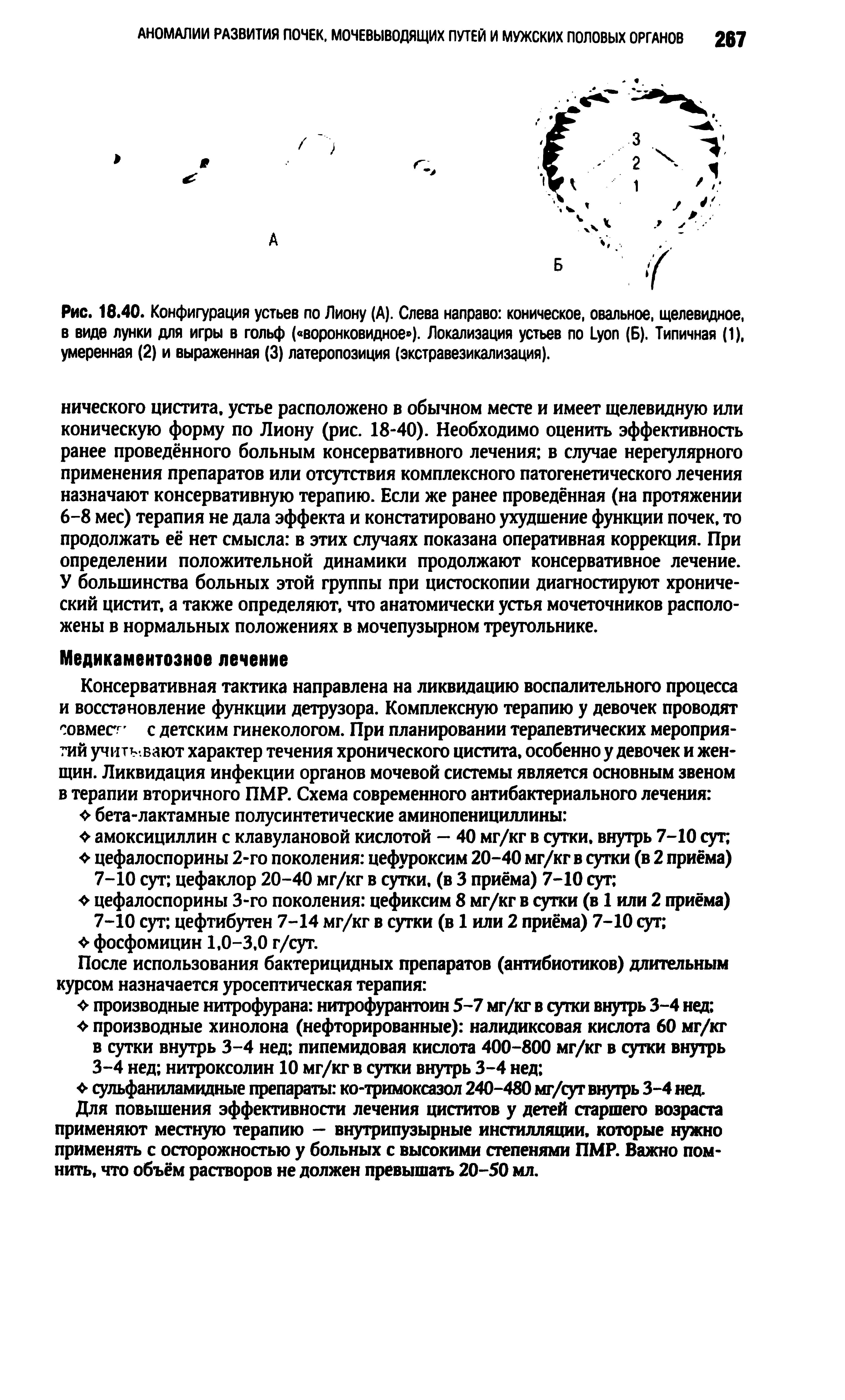 Рис. 16.40. Конфигурация устьев по Лиону (А). Слева направо коническое, овальное, щелевидное, в виде лунки для игры в гольф ( воронковидное ). Локализация устьев по L (Б). Типичная (1), умеренная (2) и выраженная (3) латеропоэиция (экстравезикализация).