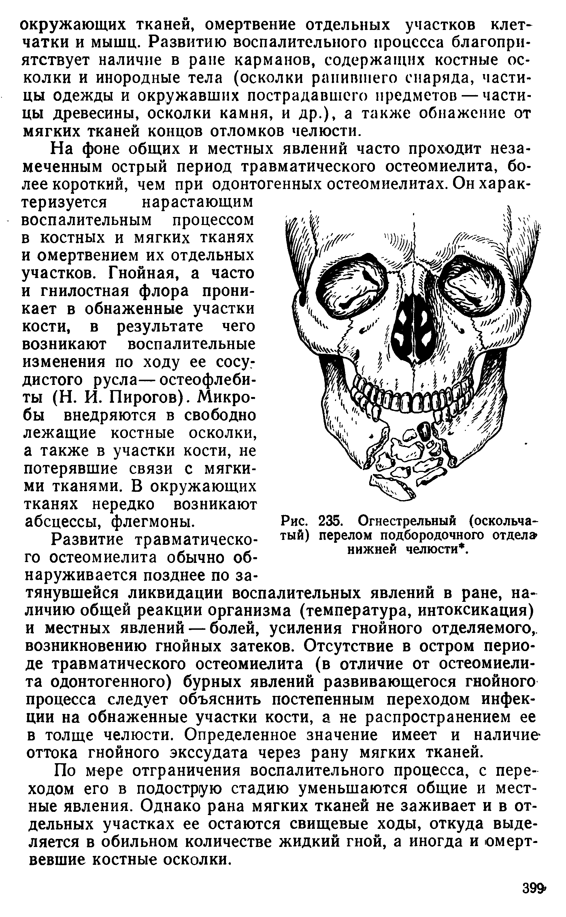 Рис. 235. Огнестрельный (оскольчатый) перелом подбородочного отдел нижней челюсти. ...