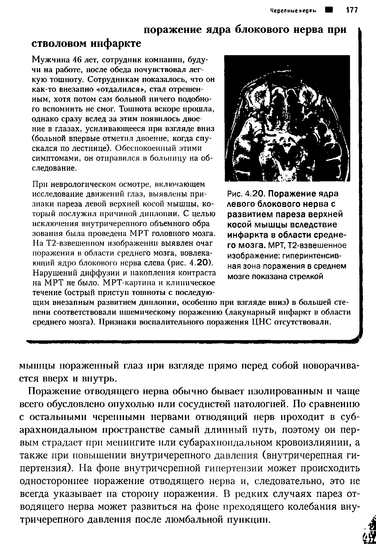 Рис. 4.20. Поражение ядра левого блокового нерва с развитием пареза верхней косой мышцы вследствие инфаркта в области среднего мозга. МРТ, Т2-взвешенное изображение гиперинтенсивная зона поражения в среднем мозге показана стрелкой...