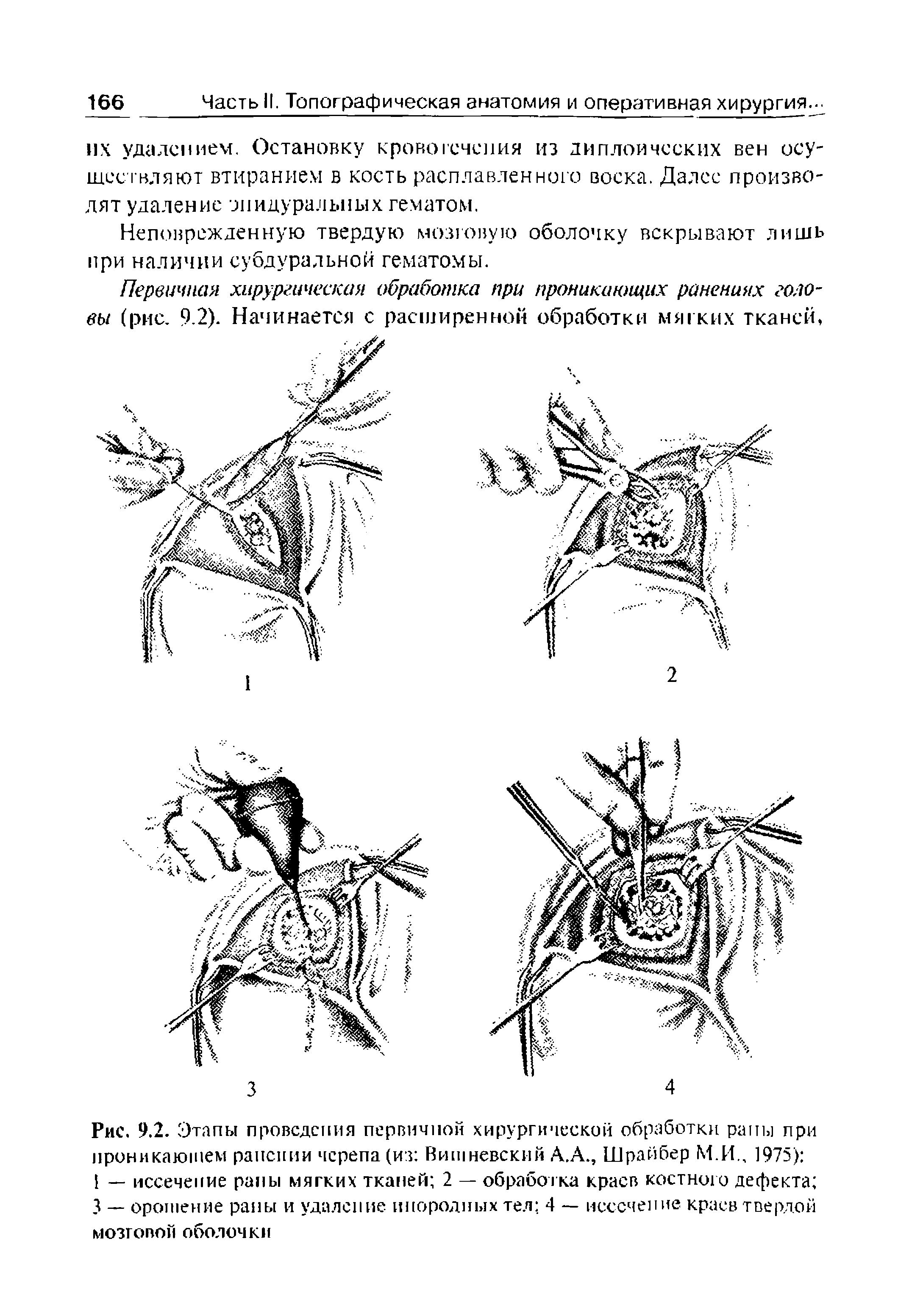 Рис. 9.2. Этапы проведения первичной хирургической обработки раны при проникающем ранении черепа (из Вишневский А.А., Шрайбер М.И., 1975) 1 — иссечение рапы мягких тканей 2 — обработка краев костного дефекта 3 — орошение раны и удаление инородных тел 4 — иссечение краев твердой мозговой оболочки...
