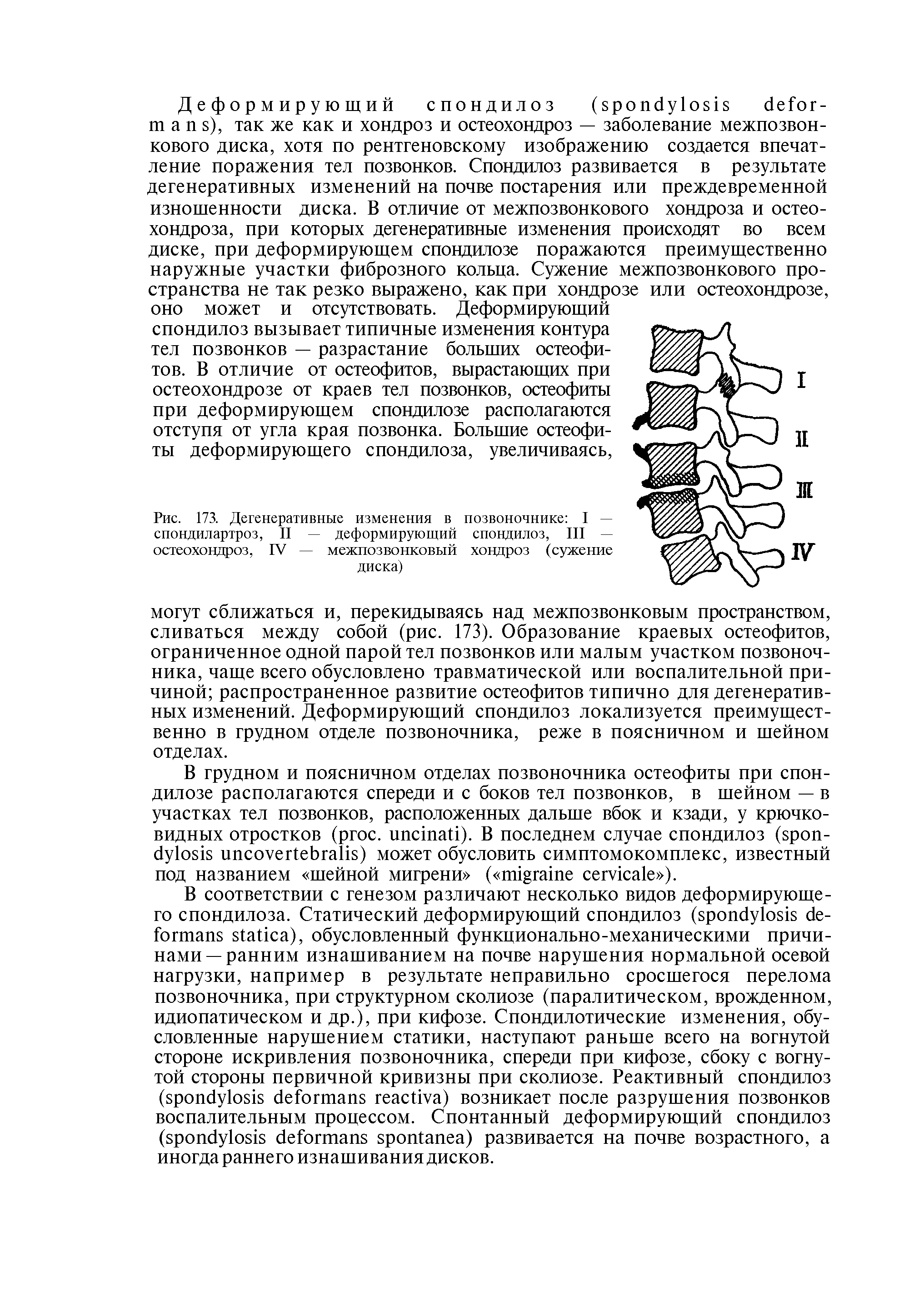 Рис. 173. Дегенеративные изменения в позвоночнике I — спондилартроз, II — деформирующий спондилоз, III — остеохондроз, IV — межпозвонковый хондроз (сужение диска)...