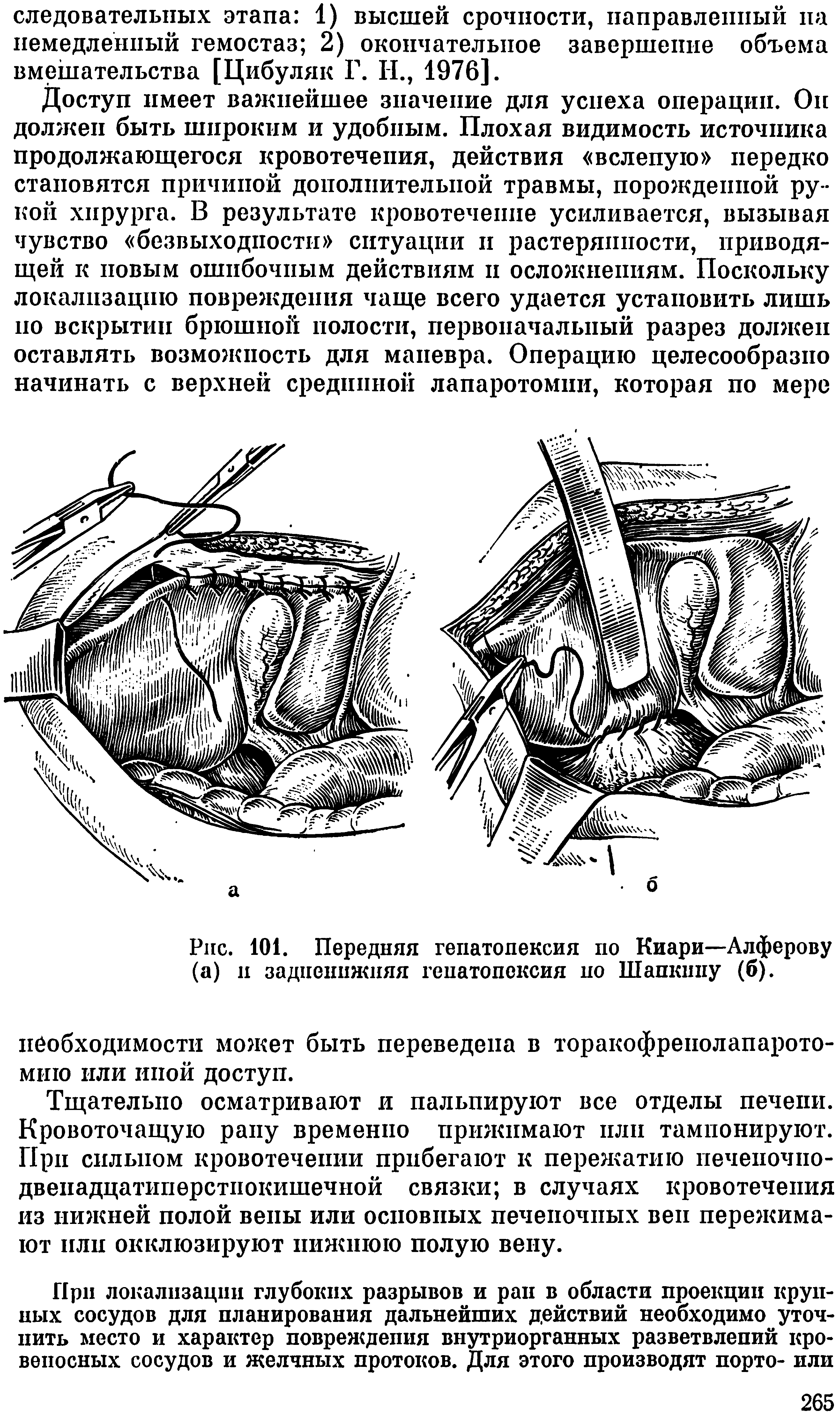 Рис. 101. Передняя гепатопексия по Киари—Алферову (а) н задненижняя гепатопексия но Шапкину (б).