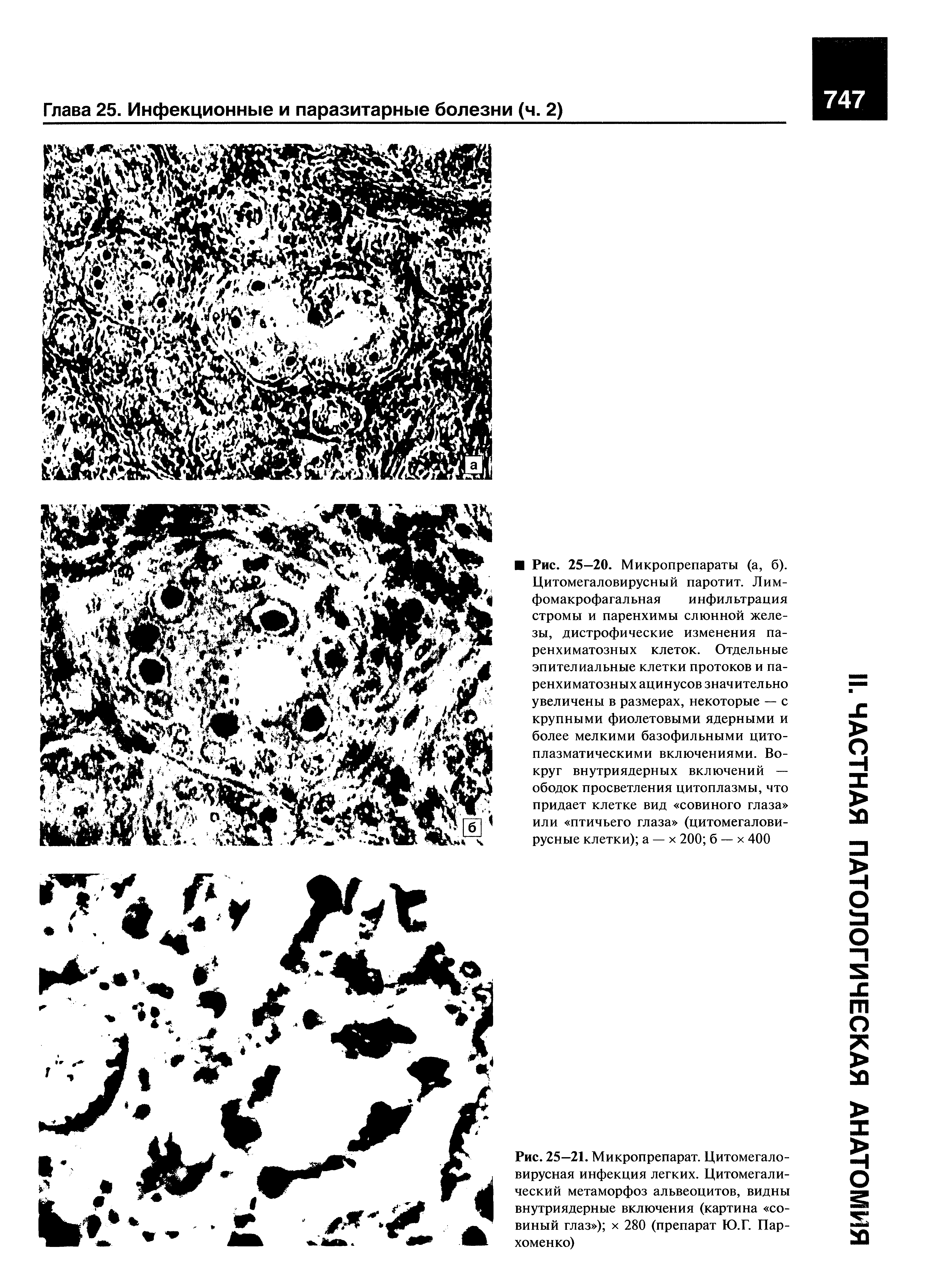 Рис. 25—21. Микропрепарат. Цитомегаловирусная инфекция легких. Цитомегалический метаморфоз альвеоцитов, видны внутриядерные включения (картина совиный глаз ) х 280 (препарат Ю.Г. Пархоменко)...