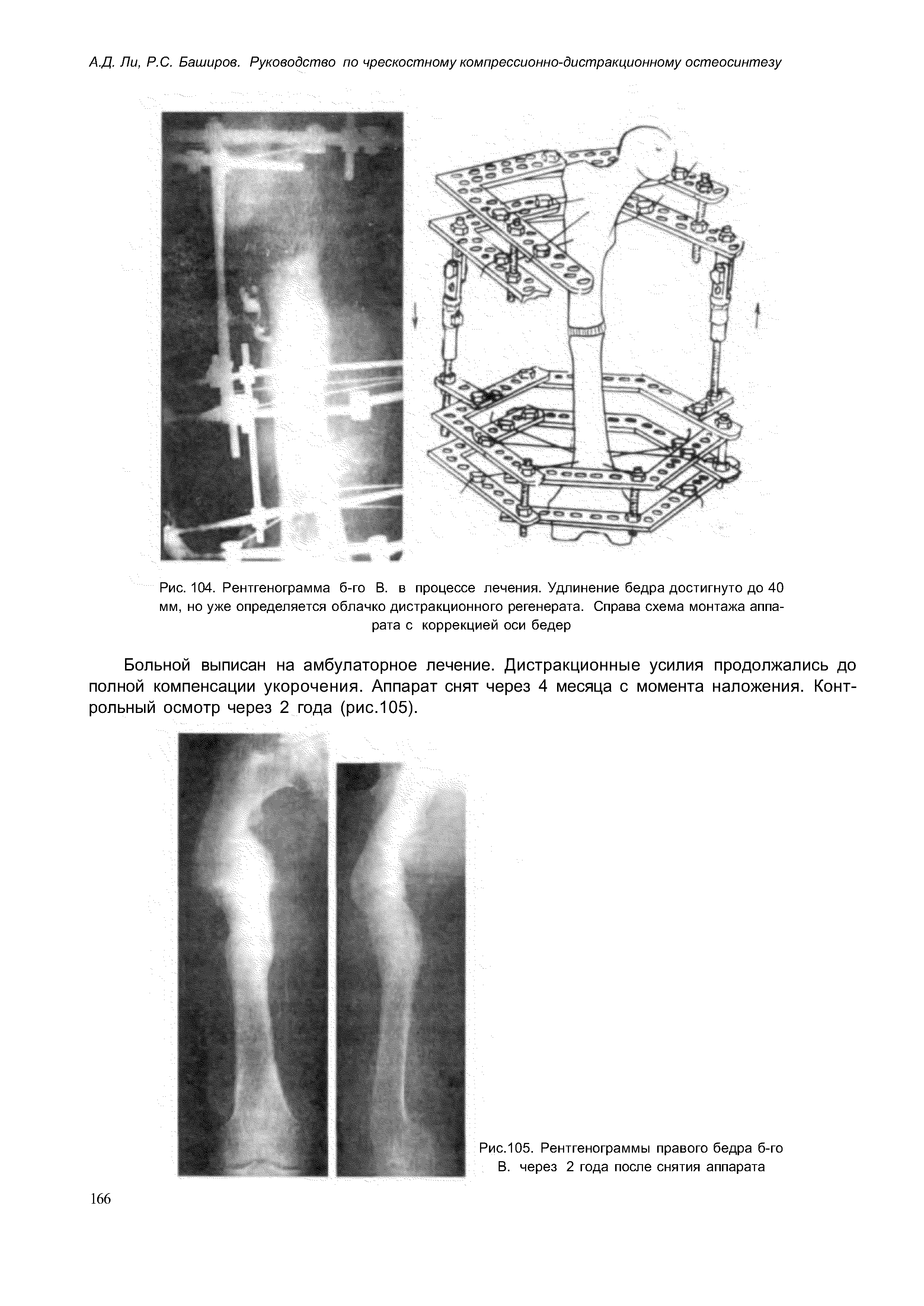 Рис. 104. Рентгенограмма б-го В. в процессе лечения. Удлинение бедра достигнуто до 40 мм, но уже определяется облачко дистракционного регенерата. Справа схема монтажа аппарата с коррекцией оси бедер...