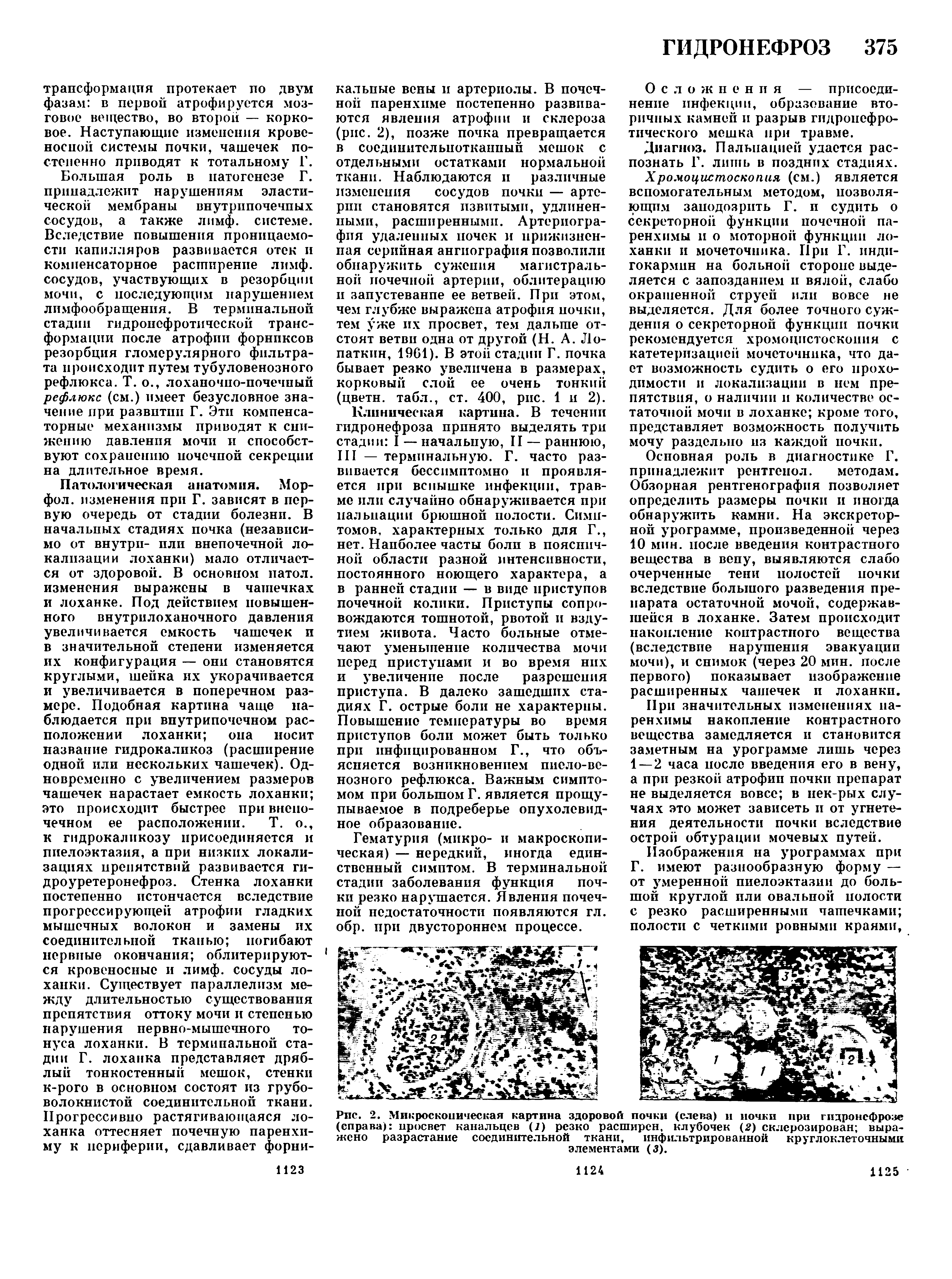 Рис. 2. Микроскопическая картина здоровой почки (слева) и почки при гидронефрозе (справа) просвет канальцев (1) резко расширен, клубочек (2) склерозирован выражено разрастание соединительной ткани, инфильтрированной круглоклеточными элементами (3).