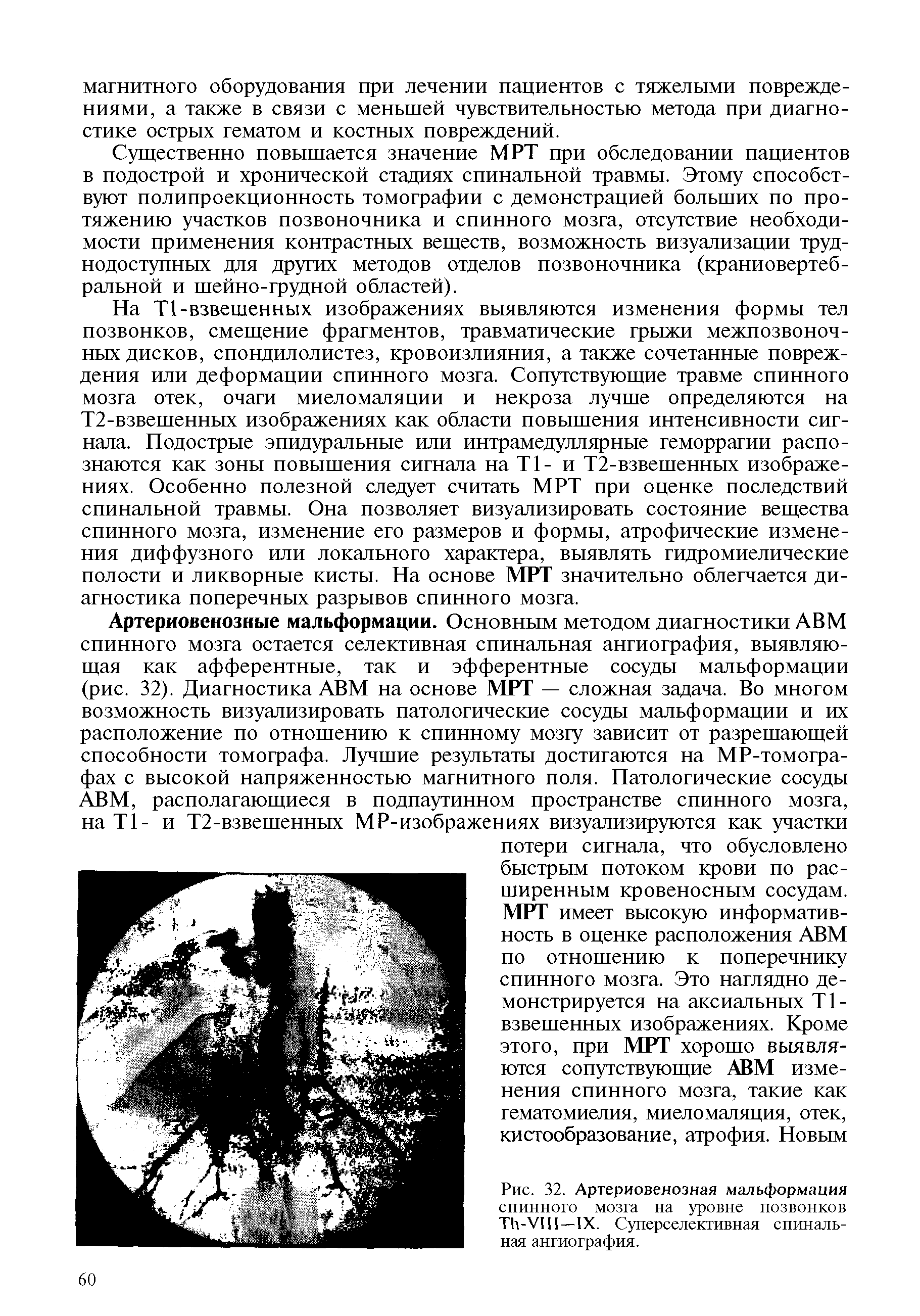 Рис. 32. Артериовенозная мальформация спинного мозга на уровне позвонков T -VI I—IX. Суперселективная спинальная ангиография.