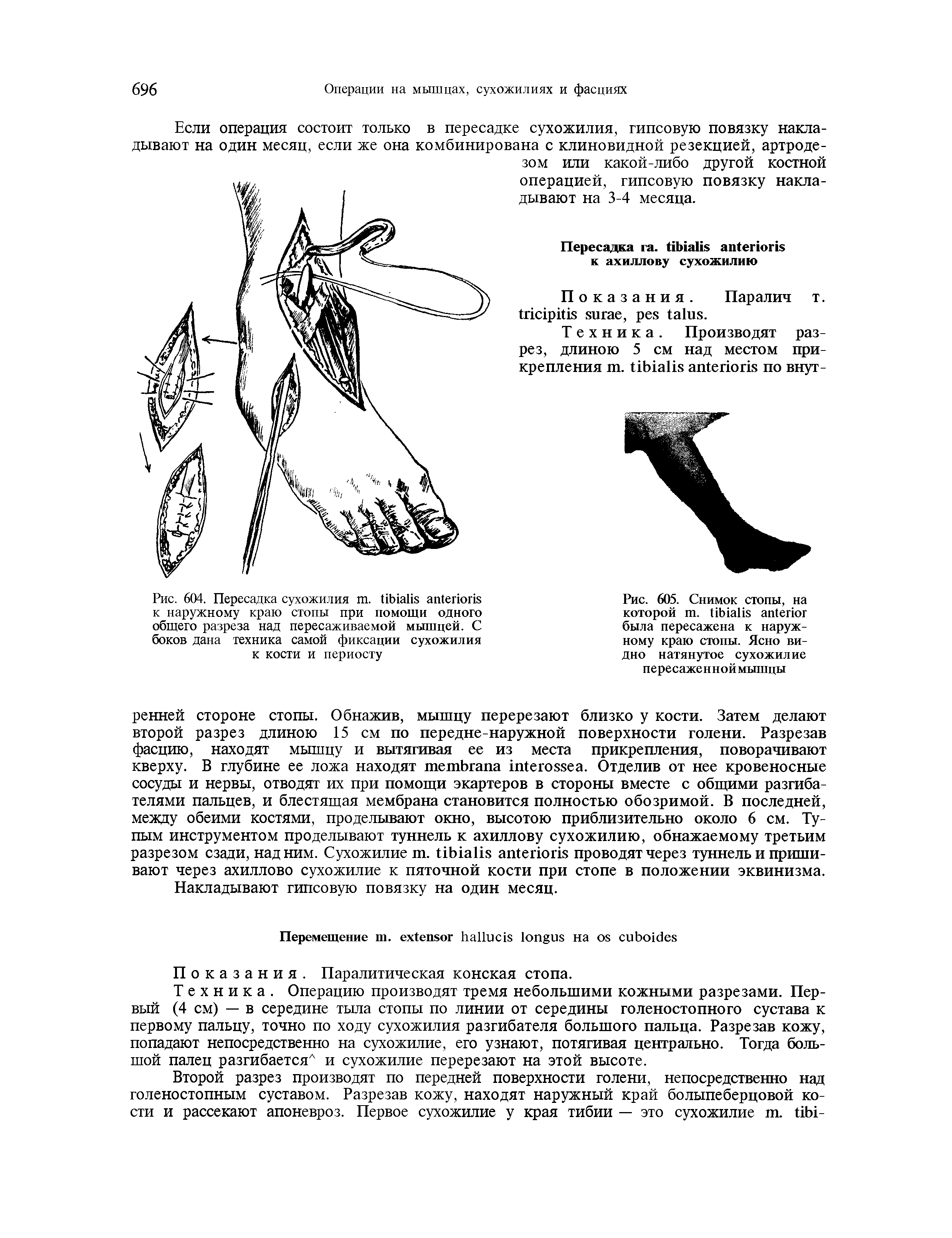 Рис. 604. Пересадка сухожилия . к наружному краю стопы при помощи одного общего разреза над пересаживаемой мышцей. С боков дана техника самой фиксации сухожилия к кости и периосту...