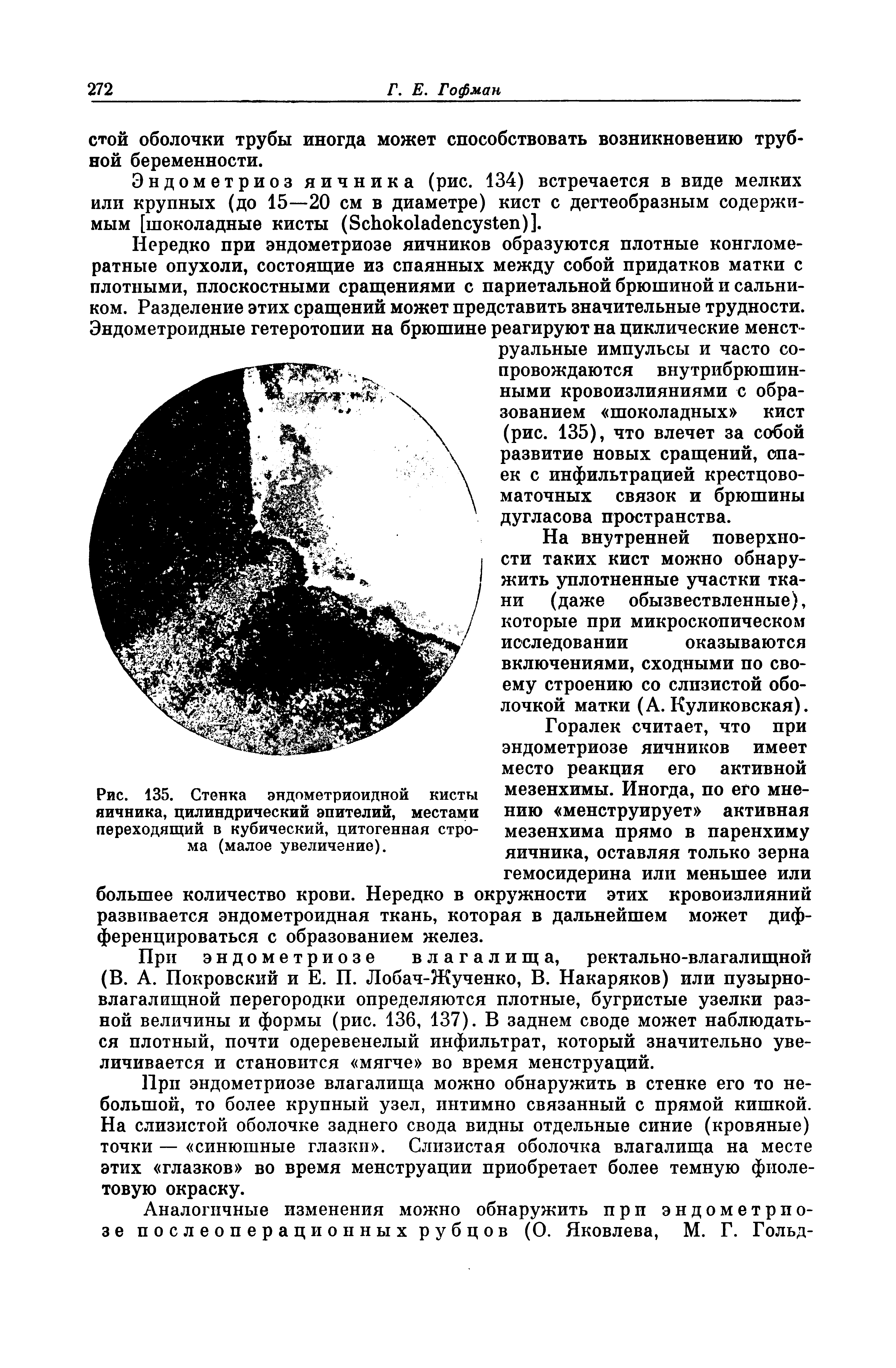 Рис. 135. Стенка эндометриоидной кисты яичника, цилиндрический эпителий, местами переходящий в кубический, цитогенная строма (малое увеличение).