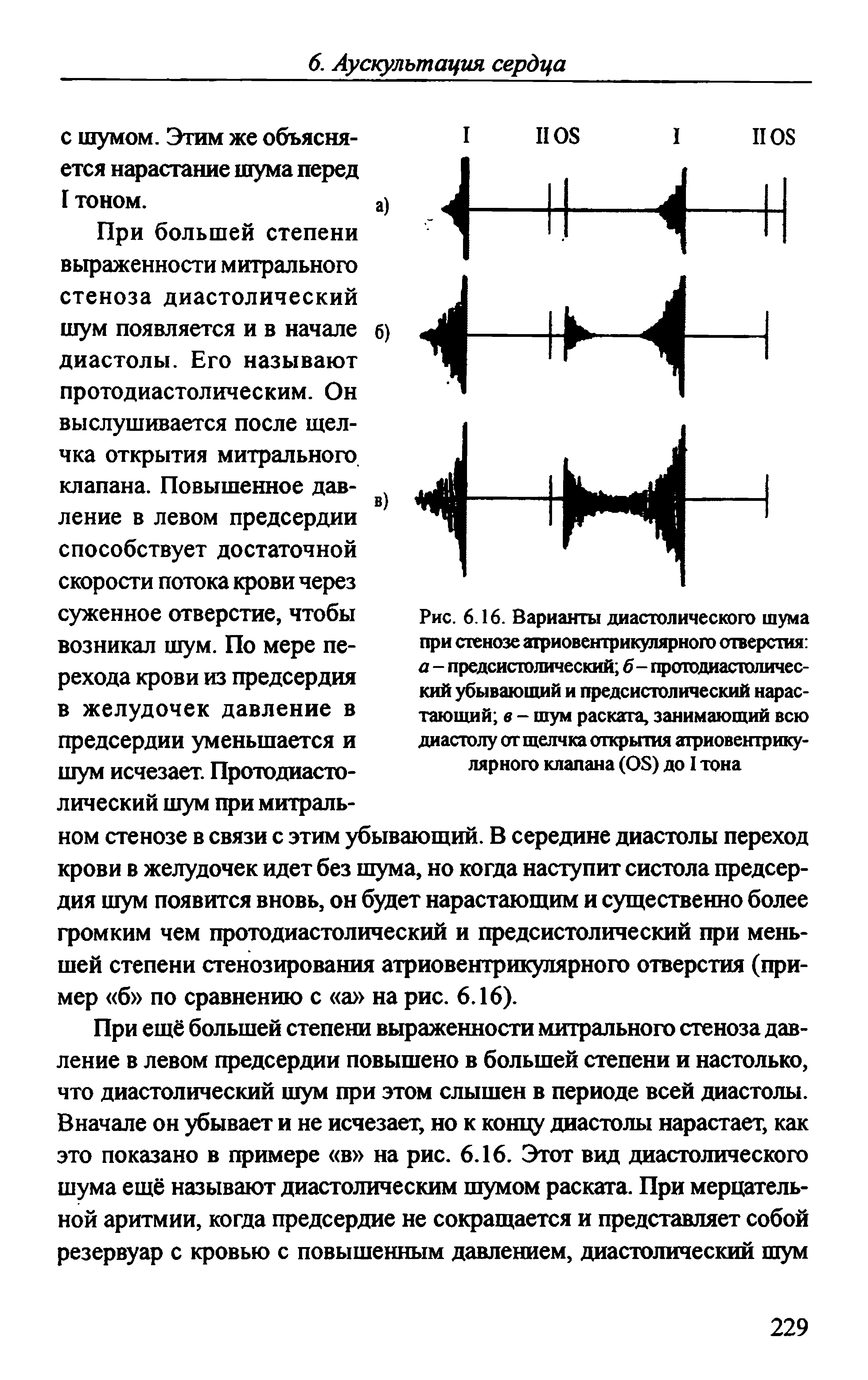 Рис. 6.16. Варианты диастолического шума при стенозе атриовентрикулярного отверстия а - предсистолический б - протодиастолический убывающий и предсистолический нарастающий в - шум раската, занимающий всю диастолу от щелчка открытия атриовентрикулярного клапана (05) до I тона...