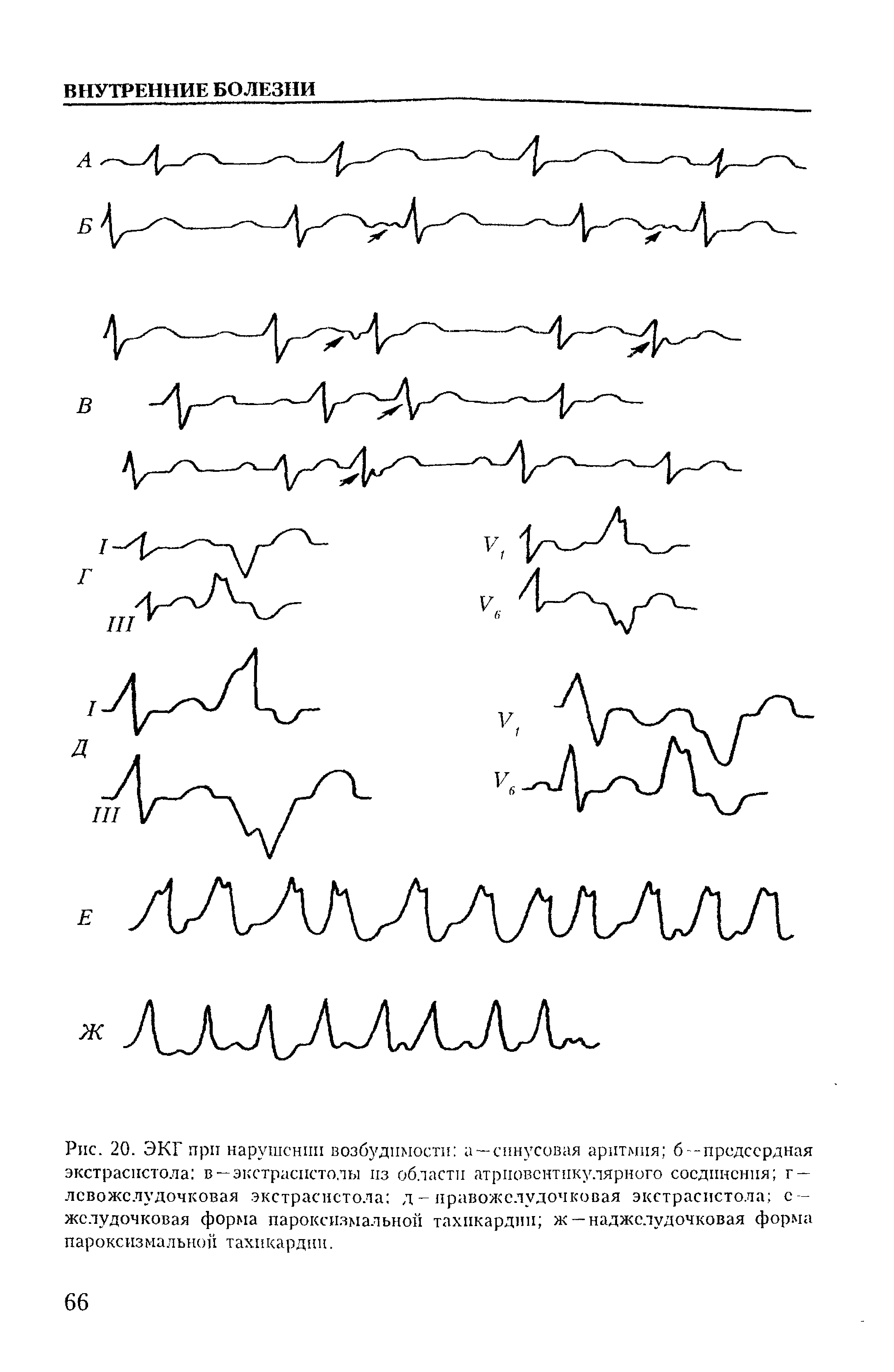 Рис. 20. ЭКГ при нарушении возбудимости а — синусовая аритмия б -предсердная экстрасистола в —экстрасистолы из области атрповентпкулярного соединения г — лсвожслудочковая экстрасистола д - правожелудочковая экстрасистола с — желудочковая форма пароксизмальной тахикардии ж — наджелудочковая форма пароксизмальной тахикардии.