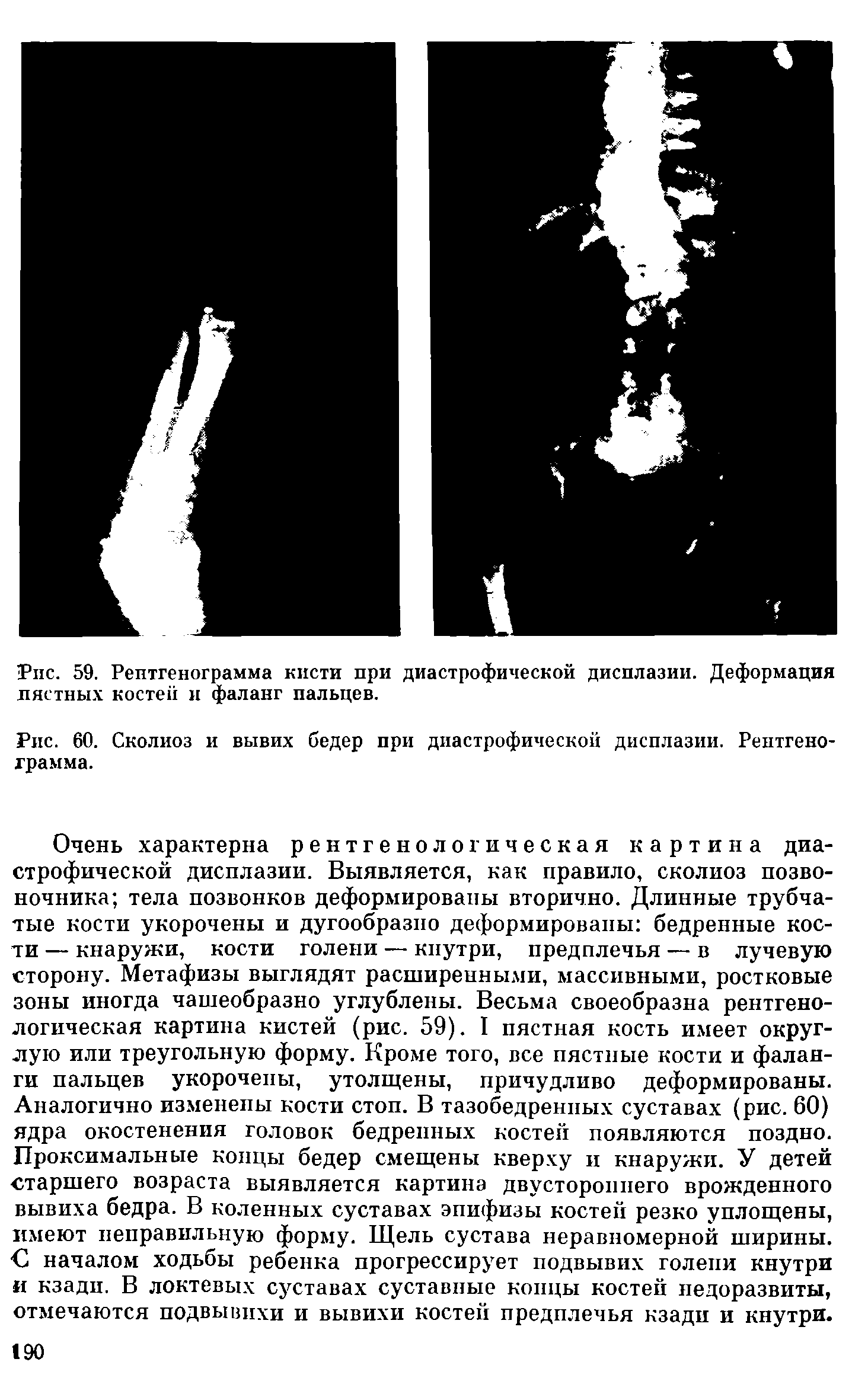 Рис. 60. Сколиоз и вывих бедер при диастрофической дисплазии. Рентгенограмма.