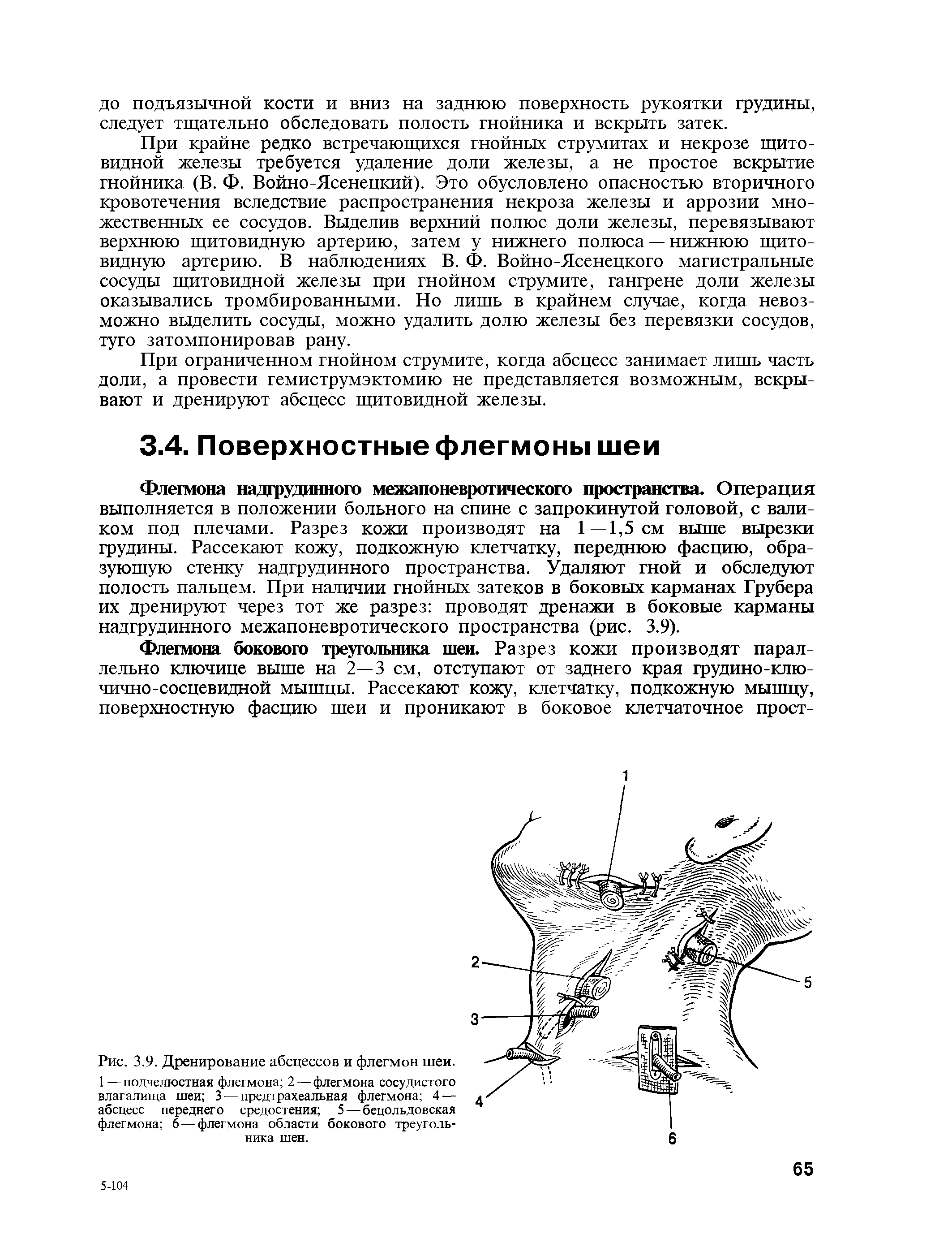 Рис. 3.9. Дренирование абсцессов и флегмон шеи. 1 —подчелюстная флегмона 2 — флегмона сосудистого влагалища шеи 3 — предтрахеальная флегмона 4 — абсцесс переднего средостения 5 — бецольдовская флегмона 6 — флегмона области бокового треугольника шен.