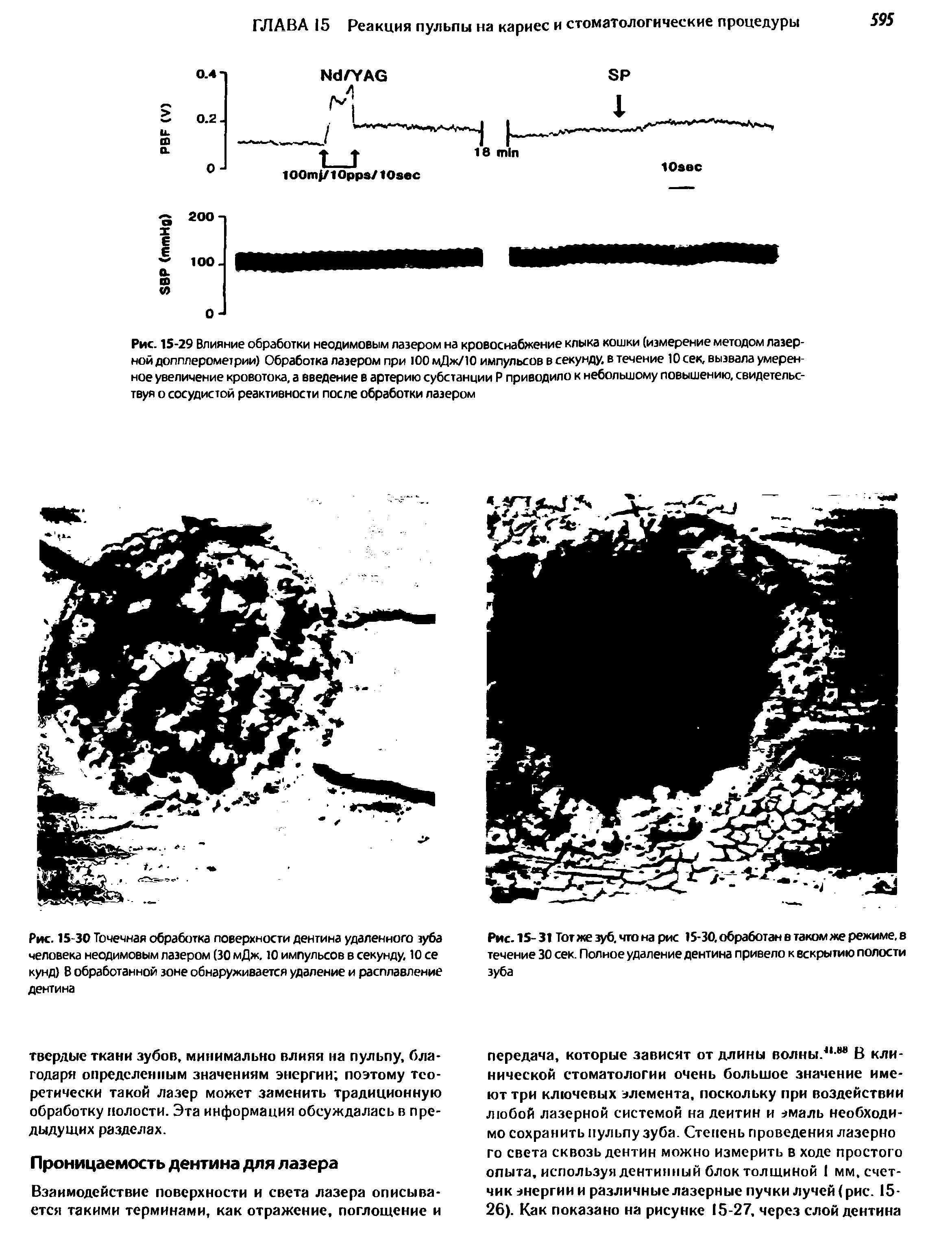 Рис. 15-30 Точечная обработка поверхности дентина удаленного зуба человека неодимовым лазером (30 мДж. 10 импульсов в секунду, 10 се кунд) В обработанной зоне обнаруживается удаление и расплавление дентина...