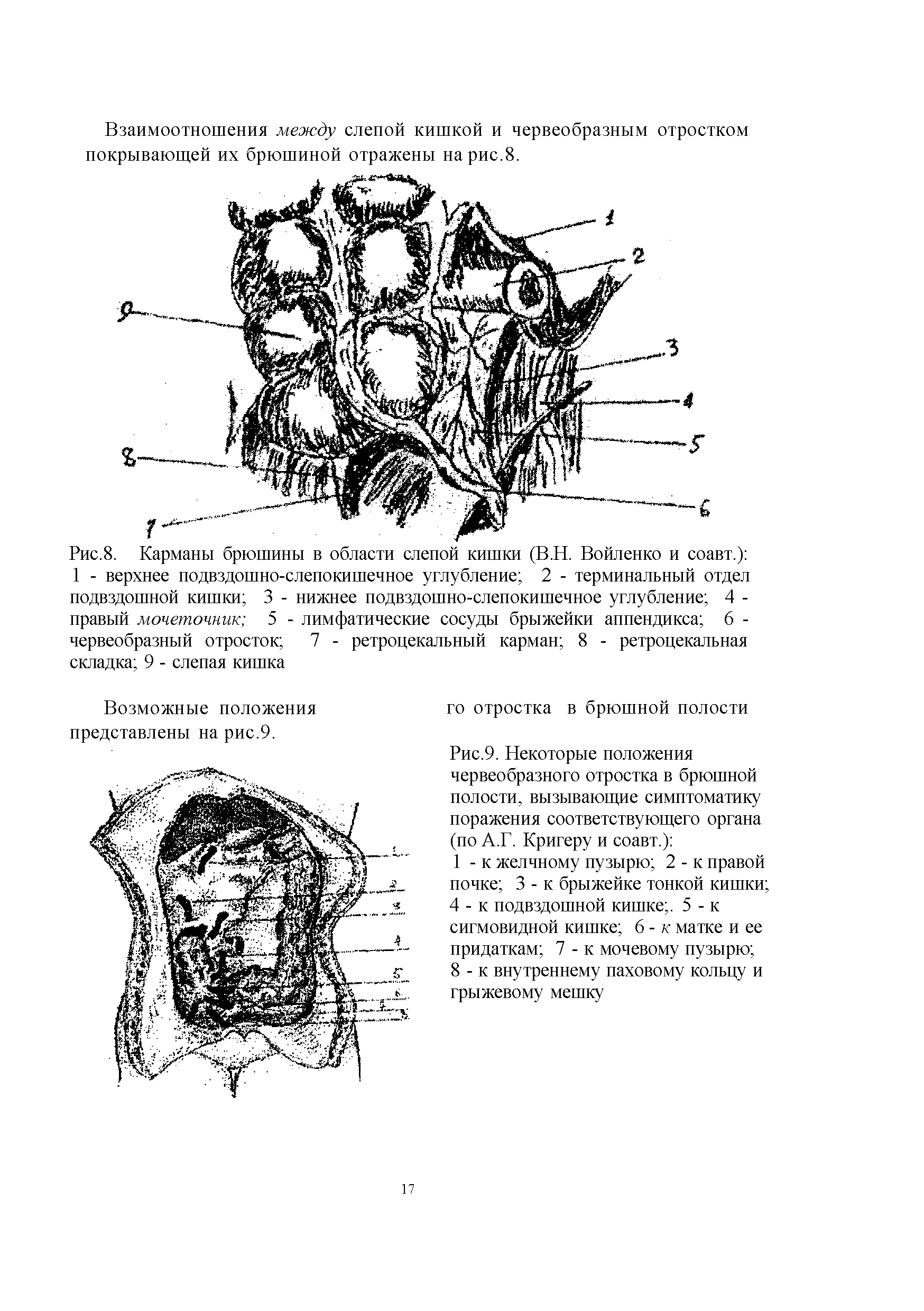 Рис.8. Карманы брюшины в области слепой кишки (В.Н. Войленко и соавт.) 1 - верхнее подвздошно-слепокишечное углубление 2 - терминальный отдел подвздошной кишки 3 - нижнее подвздошно-слепокишечное углубление 4 -правый мочеточник 5 - лимфатические сосуды брыжейки аппендикса 6 -червеобразный отросток 7 - ретроцекальный карман 8 - ретроцекальная складка 9 - слепая кишка...