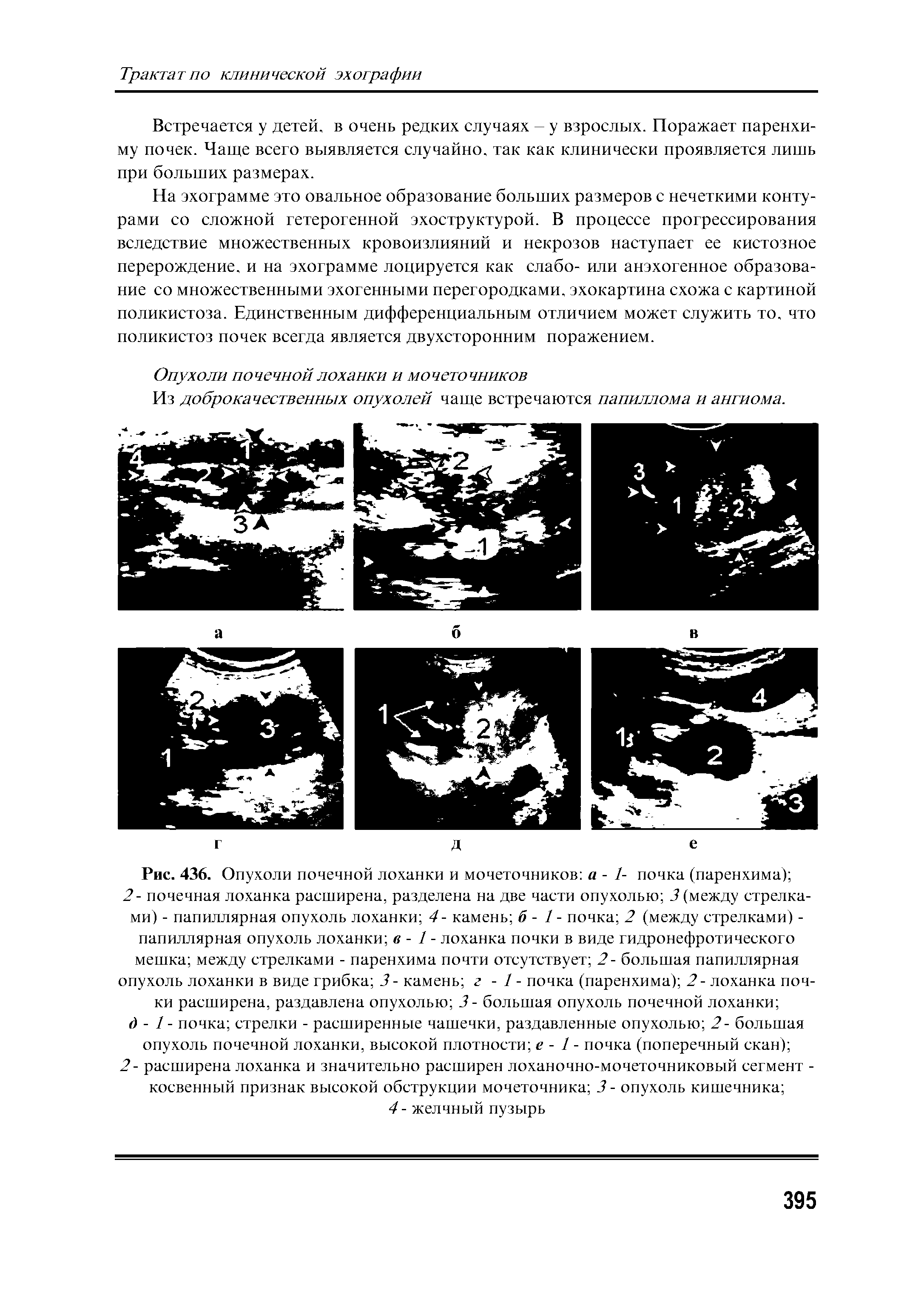 Рис. 436. Опухоли почечной лоханки и мочеточников а - 1- почка (паренхима) ...