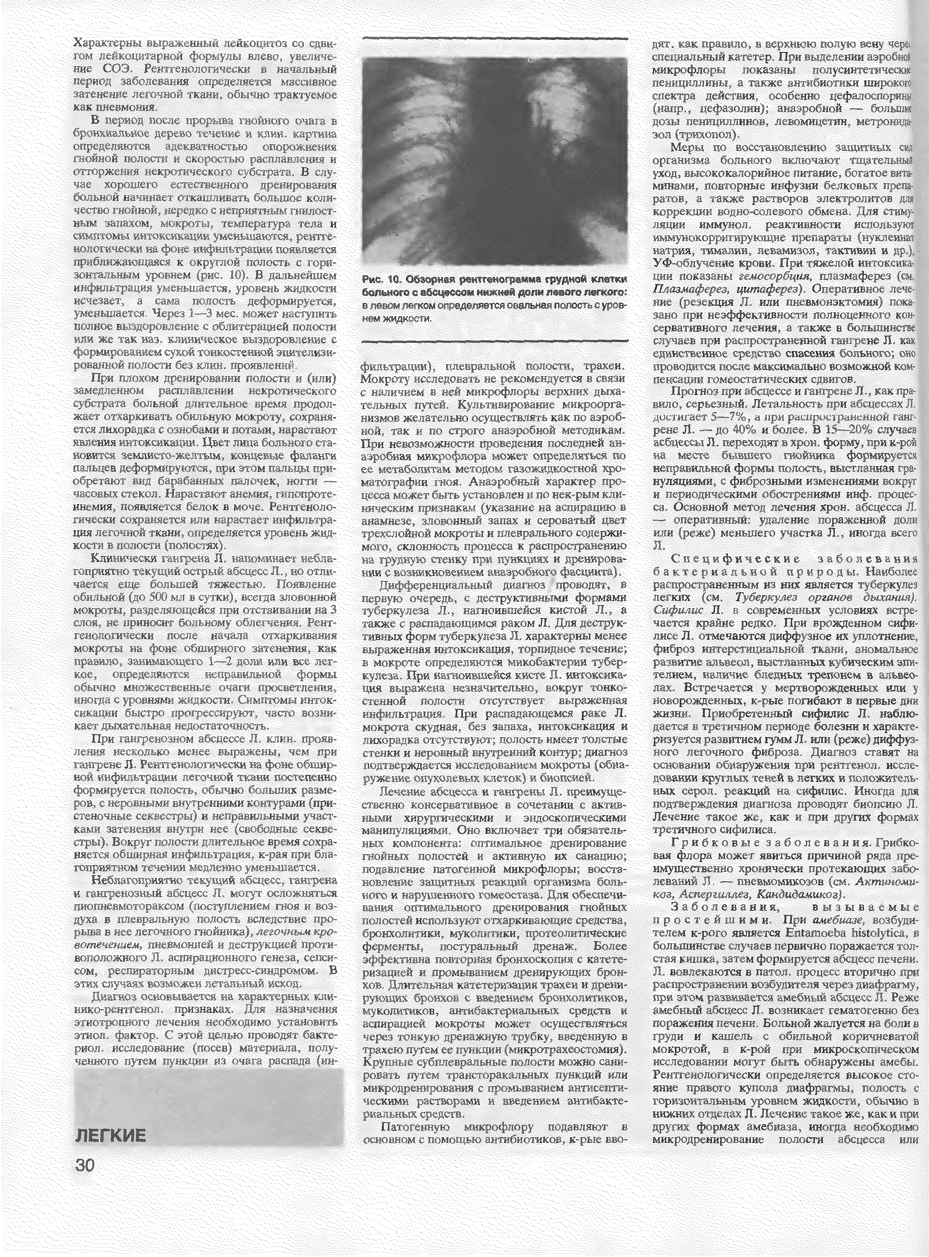 Рис. 10. Обзорная рентгенограмма грудной клетки бального с абсцессом нижней доли левого лвгкогог р , <м "4К0М1Л /едетяетсяг сальнаяггжоса,. уг"в 1 ЙЖ к й1 И ЖИ ...