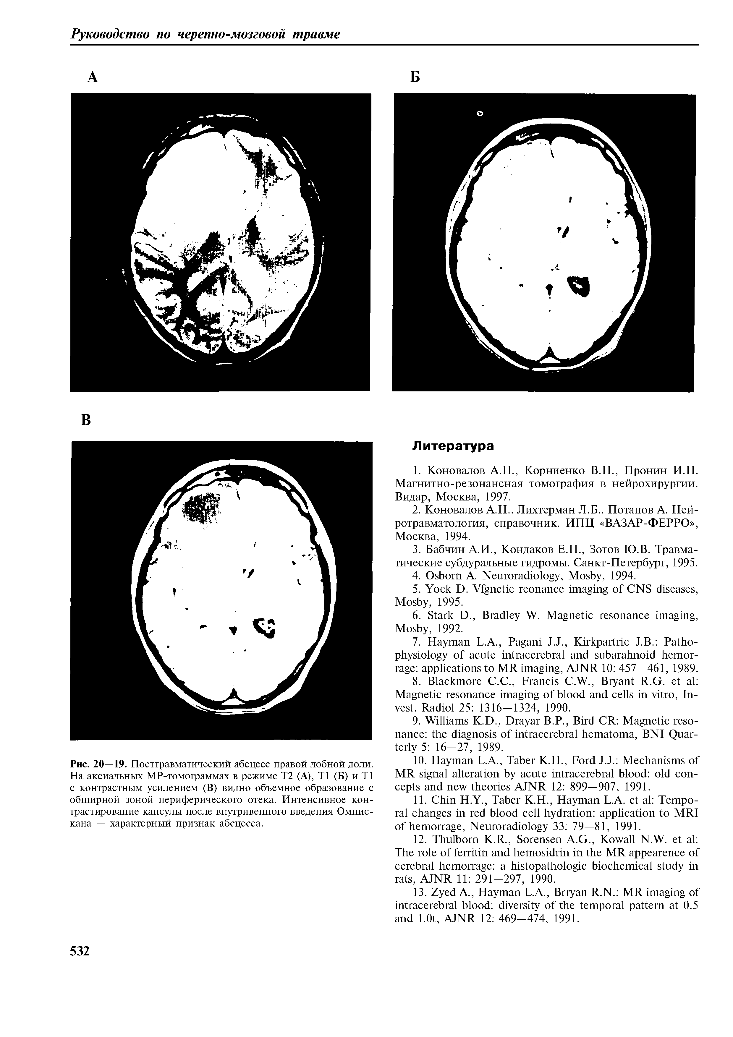 Рис. 20—19. Посттравматический абсцесс правой лобной доли. На аксиальных МР-томограммах в режиме Т2 (А), Т1 (Б) и Т1 с контрастным усилением (В) видно объемное образование с обширной зоной периферического отека. Интенсивное контрастирование капсулы после внутривенного введения Омнискана — характерный признак абсцесса.