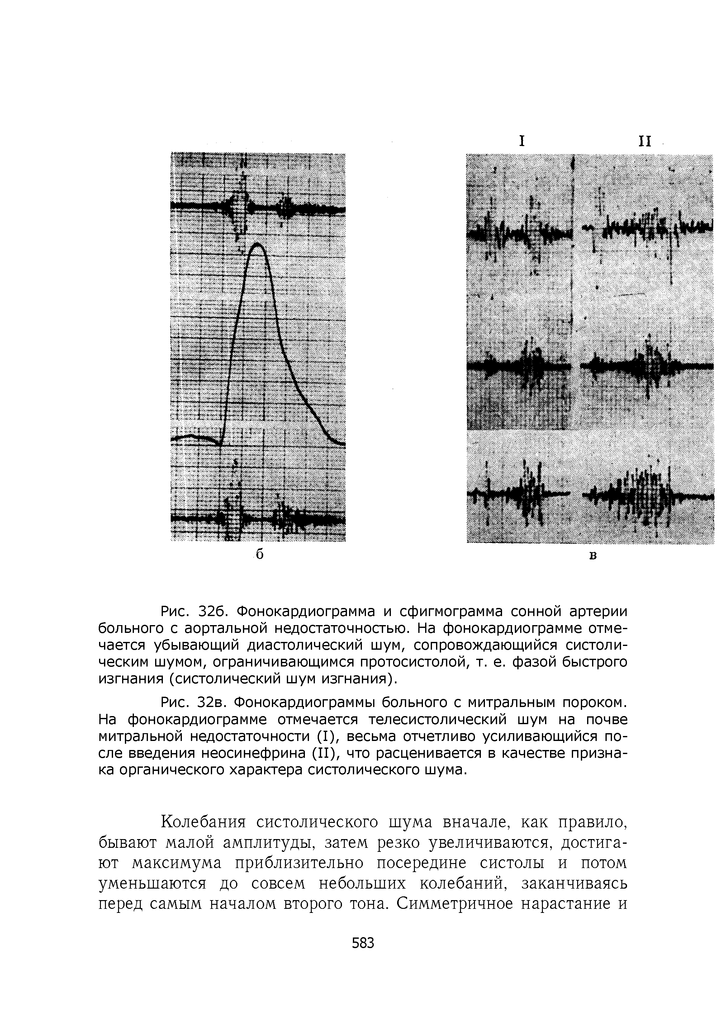 Рис. 32в. Фонокардиограммы больного с митральным пороком. На фонокардиограмме отмечается телесистолический шум на почве митральной недостаточности (I), весьма отчетливо усиливающийся после введения неосинефрина (II), что расценивается в качестве признака органического характера систолического шума.