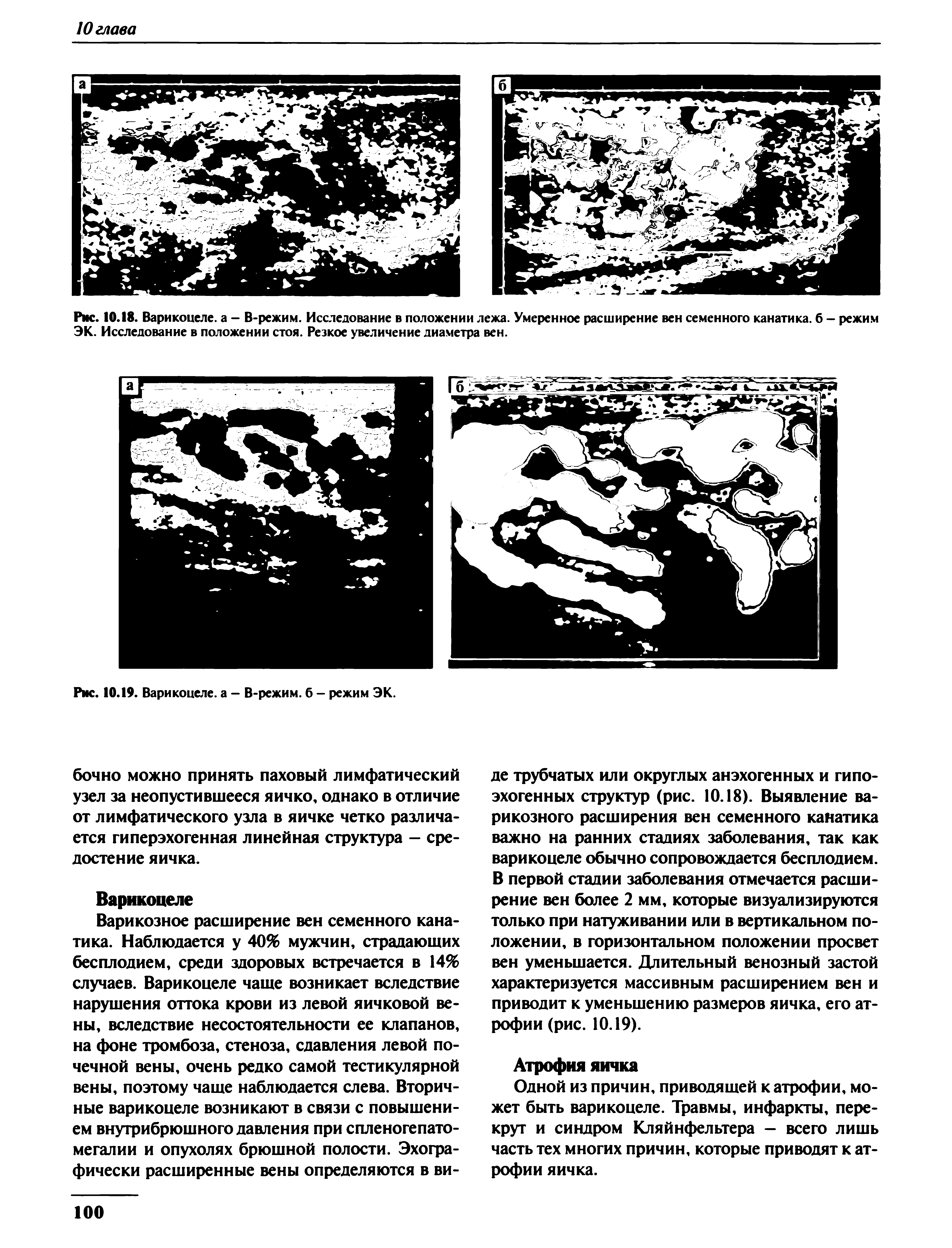 Рис. 10.18. Варикоцеле, а - В-режим. Исследование в положении лежа. Умеренное расширение вен семенного канатика. 6 - режим ЭК. Исследование в положении стоя. Резкое увеличение диаметра вен.