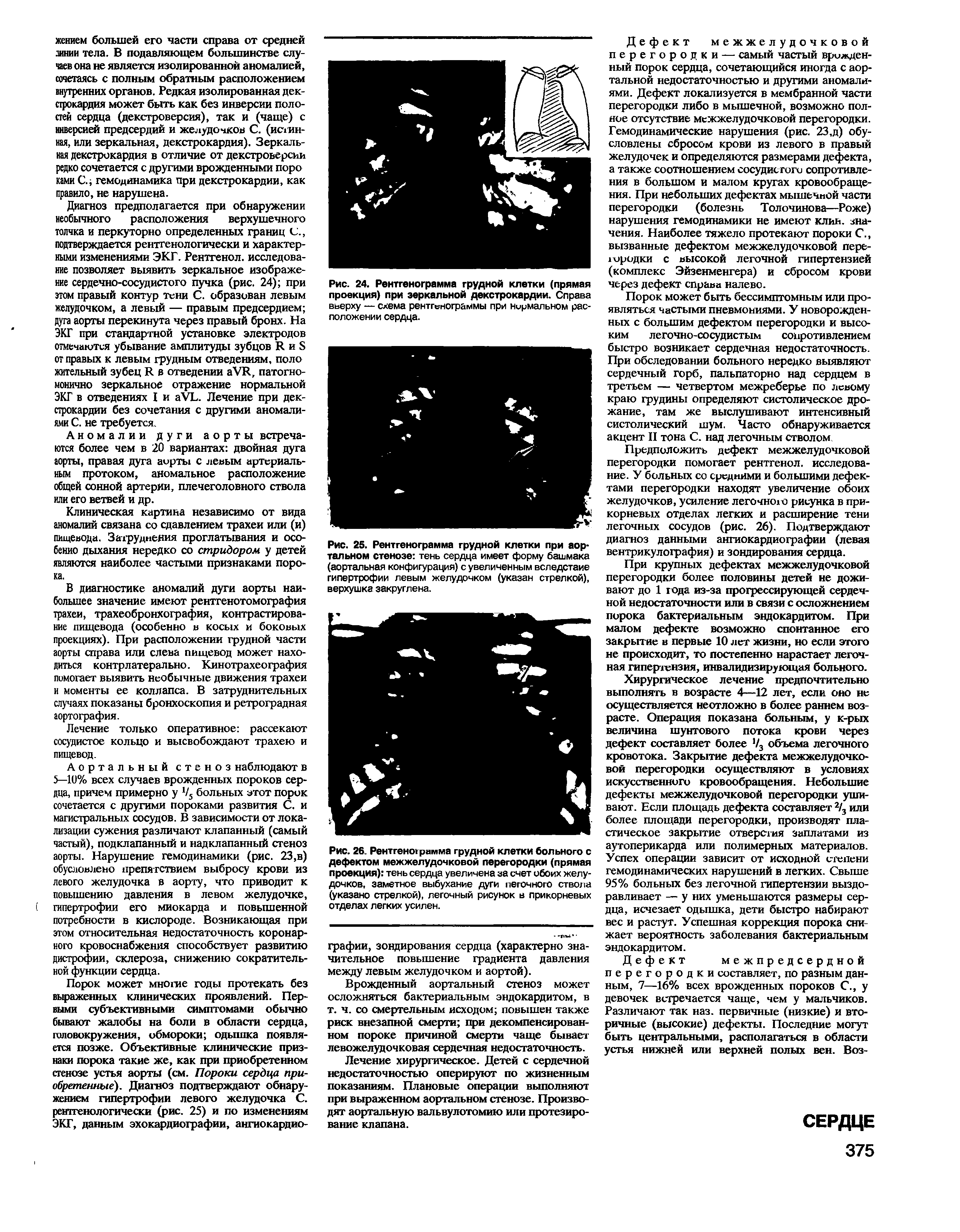 Рис. 24. Рентгенограмма грудной клетки (прямая проекция) при зеркальной декстрокардии. Справа вверху — схема рентгенограммы при нирмальном расположении сердца.