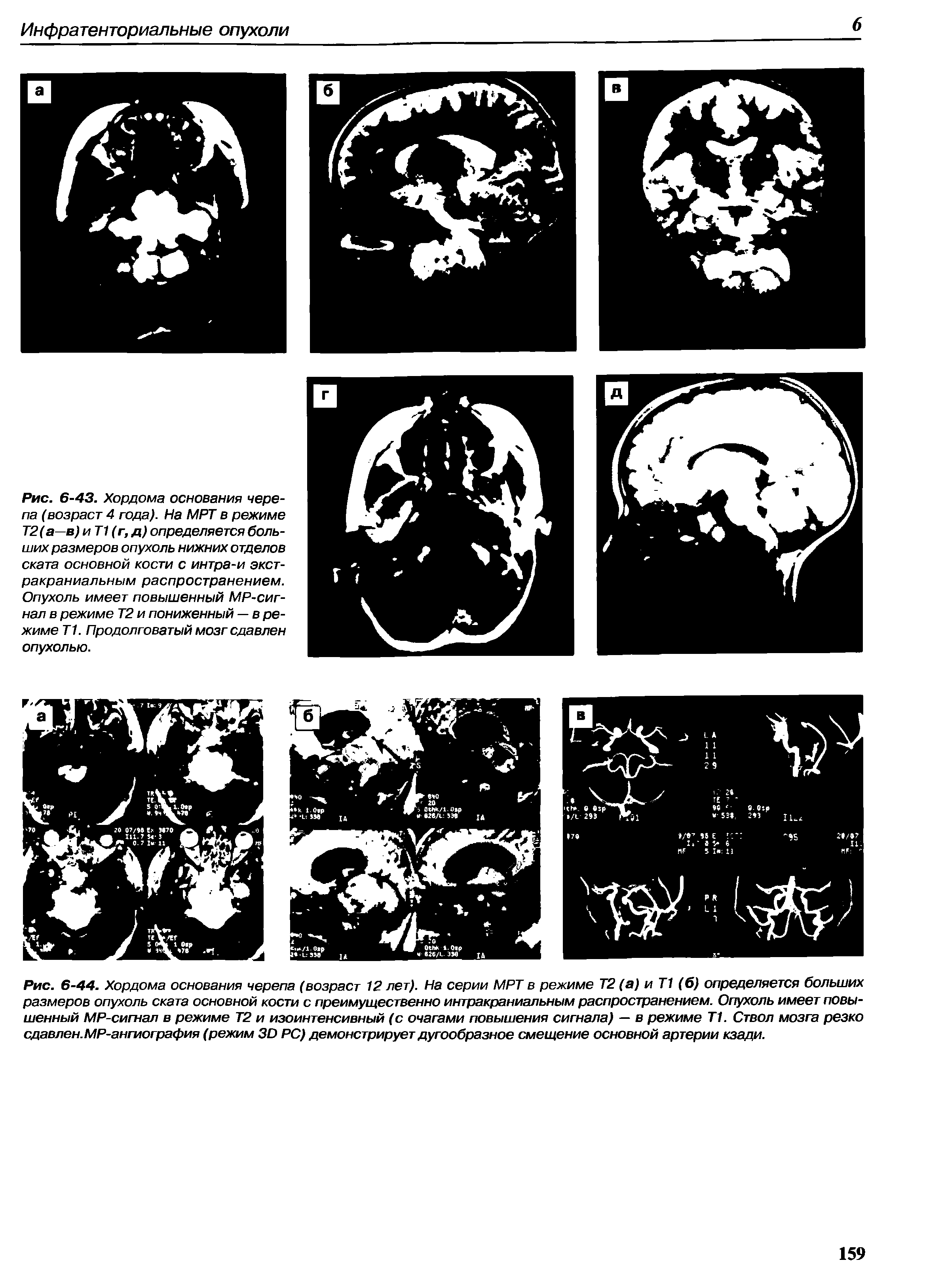 Рис. 6-43. Хордома основания черепа (возраст 4 года). На МРТ в режиме Т2(а—в) иТ1(г, д) определяется больших размеров опухоль нижних отделов ската основной кости с интра-и экстракраниальным распространением. Опухоль имеет повышенный МР-сигнал в режиме Т2 и пониженный — в режиме Т1. Продолговатый мозг сдавлен опухолью.