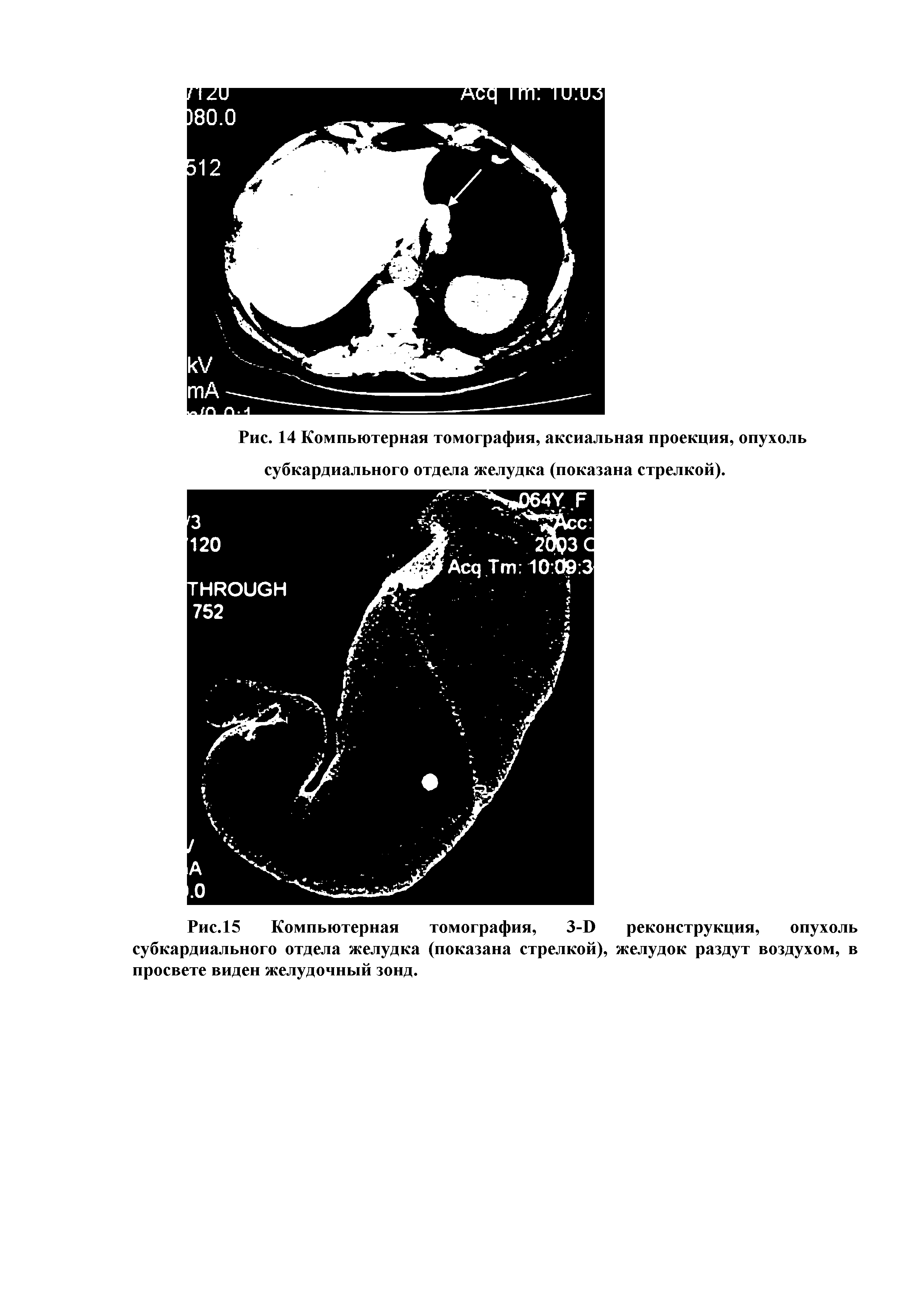 Рис.15 Компьютерная томография, З-Б реконструкция, опухоль субкардиального отдела желудка (показана стрелкой), желудок раздут воздухом, в просвете виден желудочный зонд.